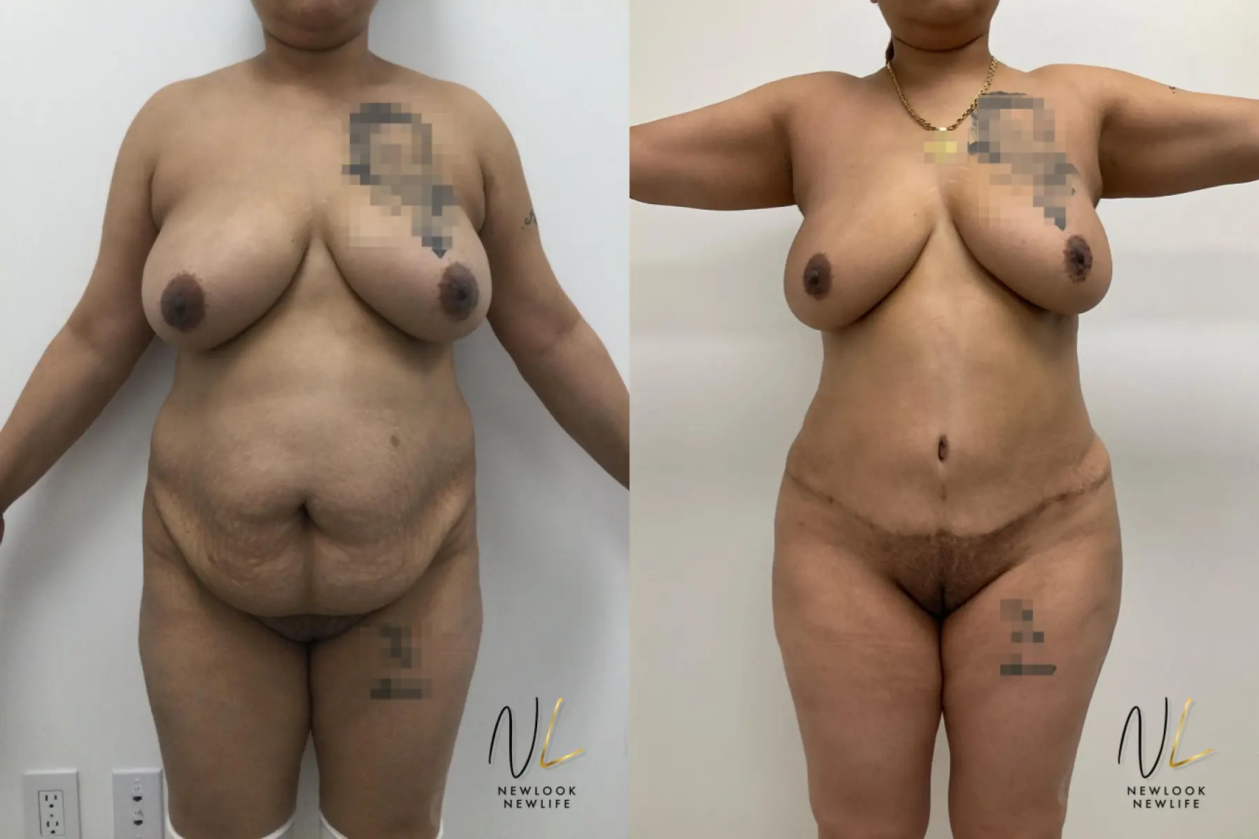 Brazilian Butt Lift: Patient 7 - Before and After  