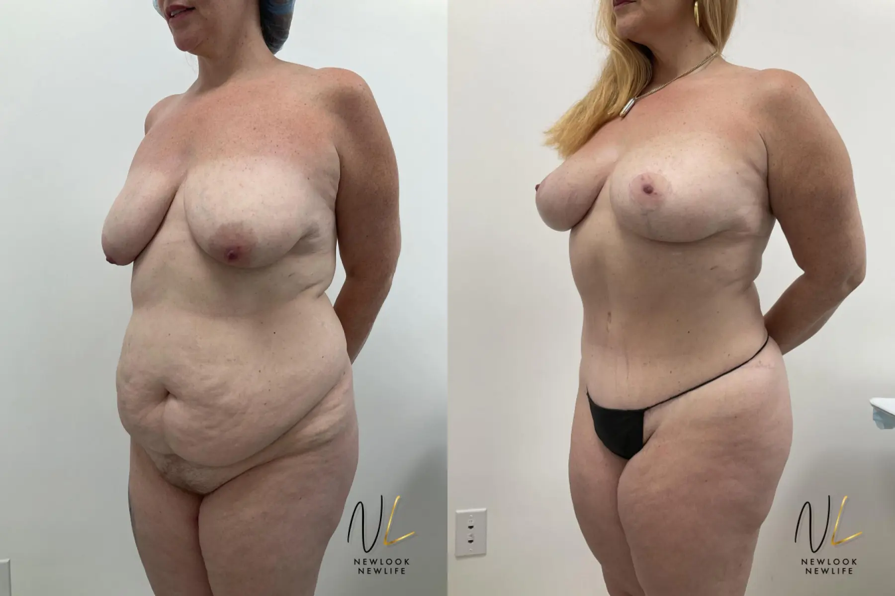 Brazilian Butt Lift: Patient 12 - Before and After 2