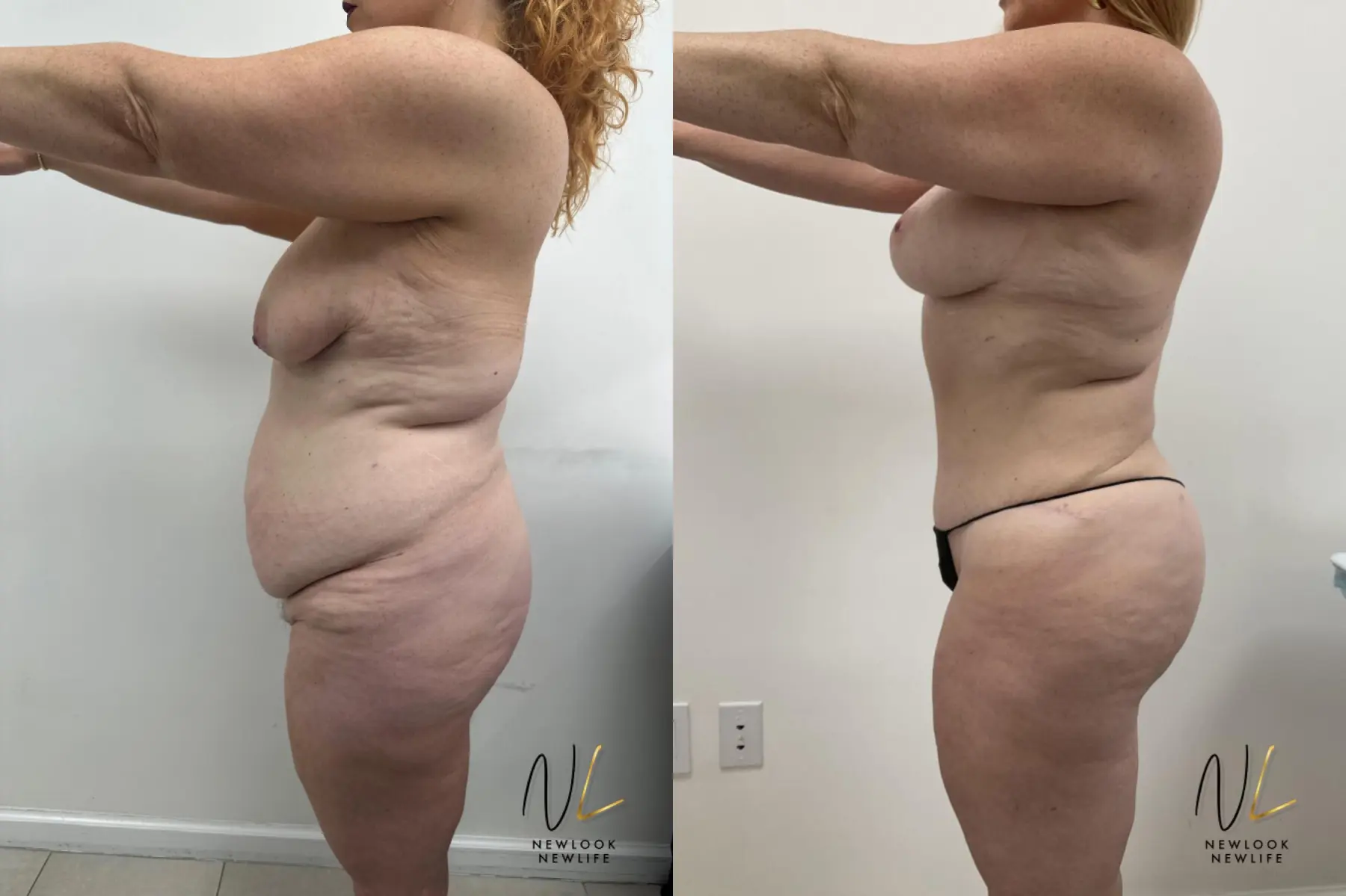 Brazilian Butt Lift: Patient 12 - Before and After 3