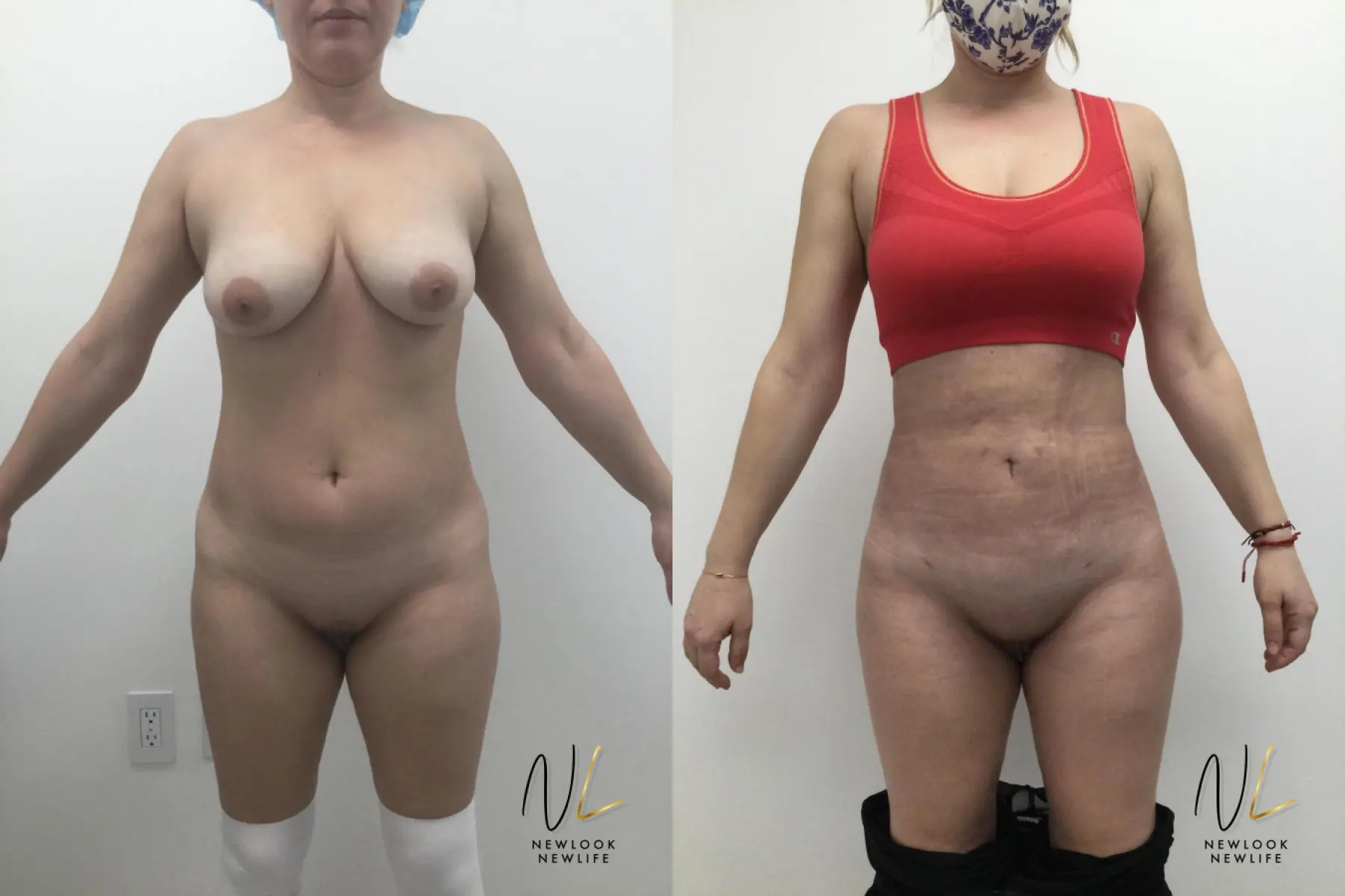 Brazilian Butt Lift: Patient 4 - Before and After 1