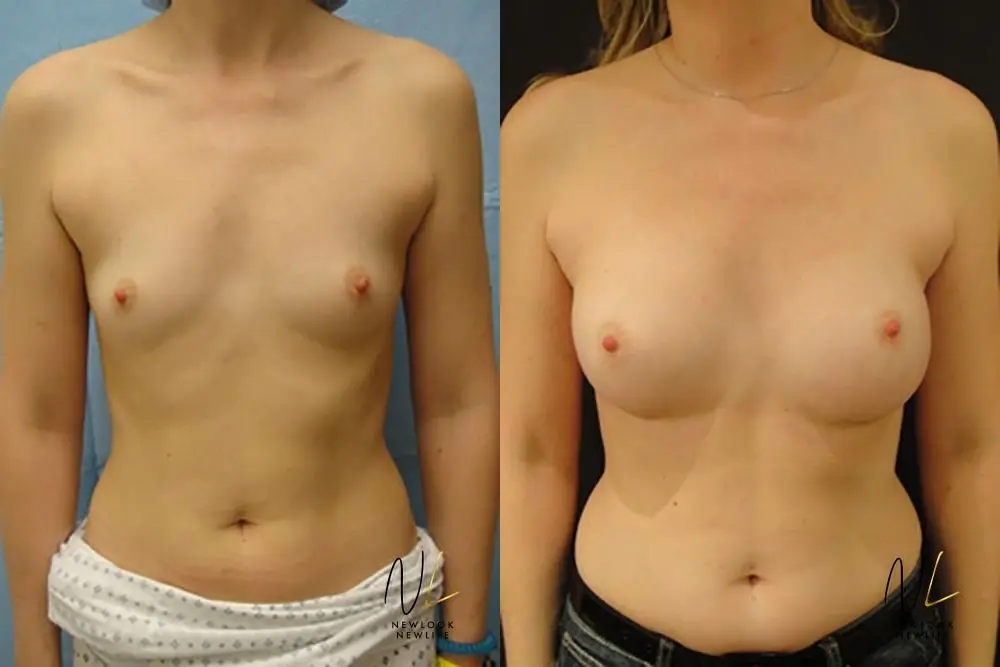 Breast Augmentation: Patient 5 - Before and After  