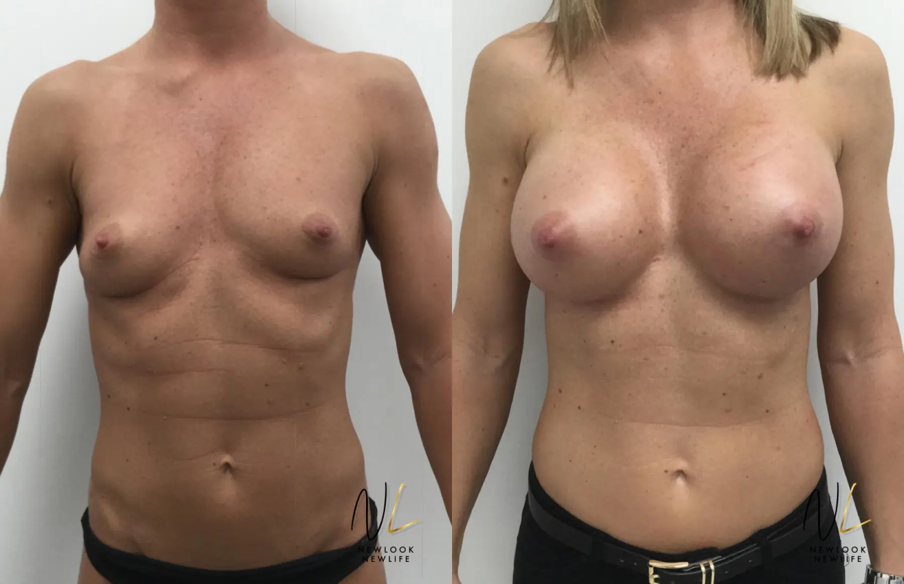 Breast Augmentation: Patient 3 - Before and After  