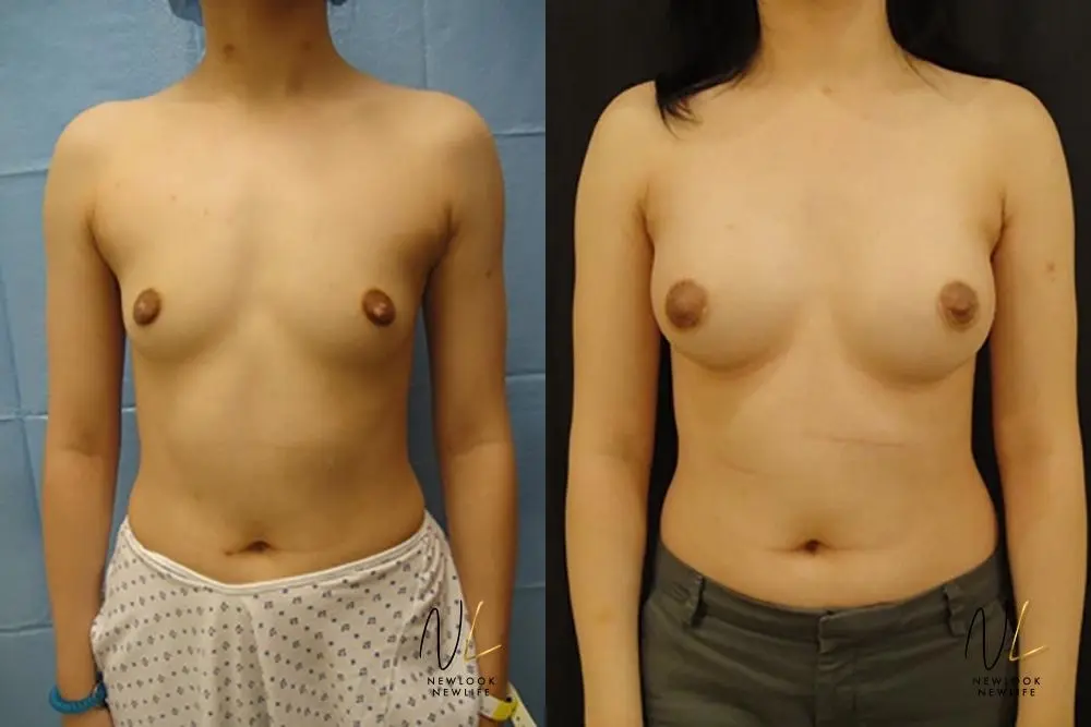 Breast Augmentation: Patient 4 - Before and After  