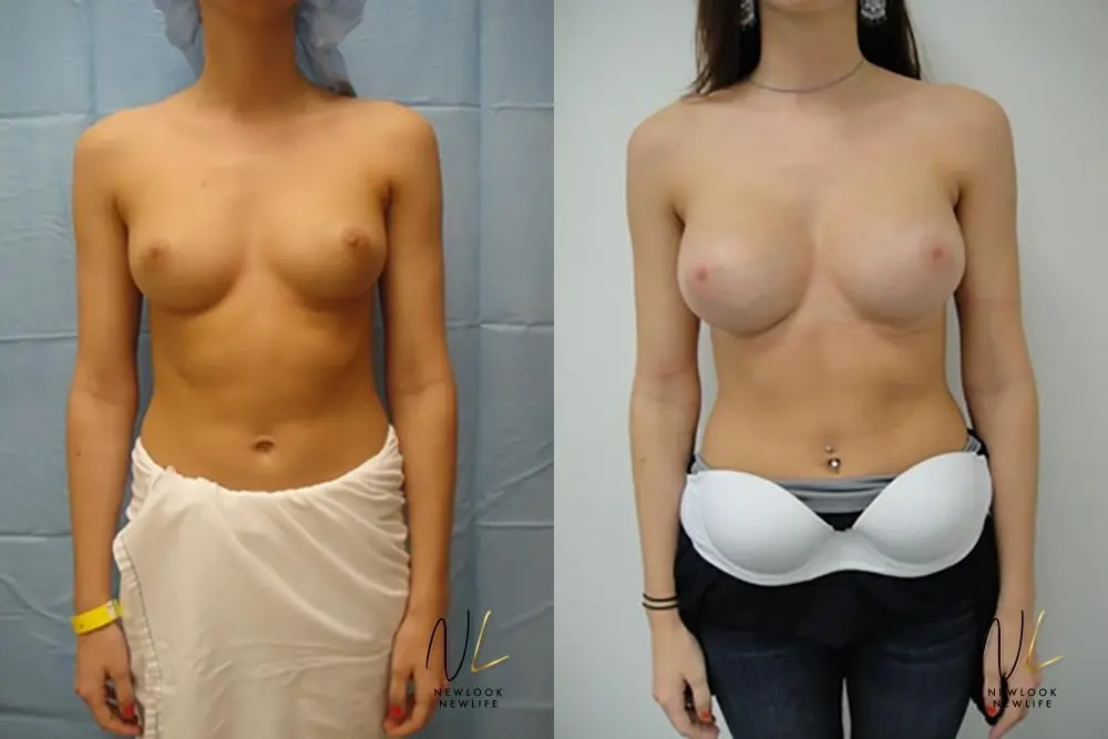 Breast Augmentation: Patient 6 - Before and After  