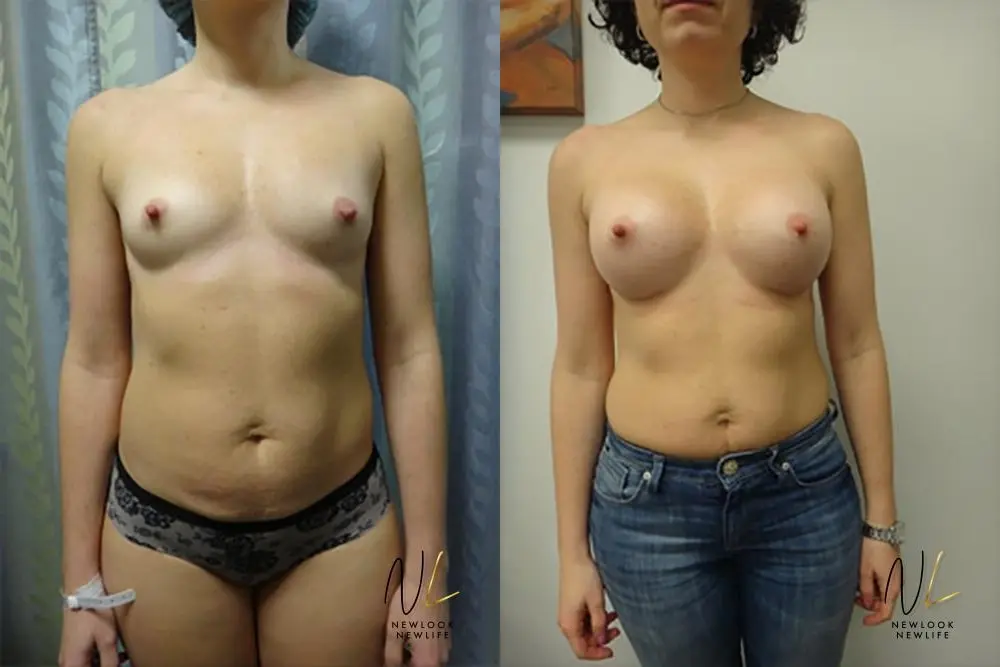 Breast Augmentation: Patient 9 - Before and After  