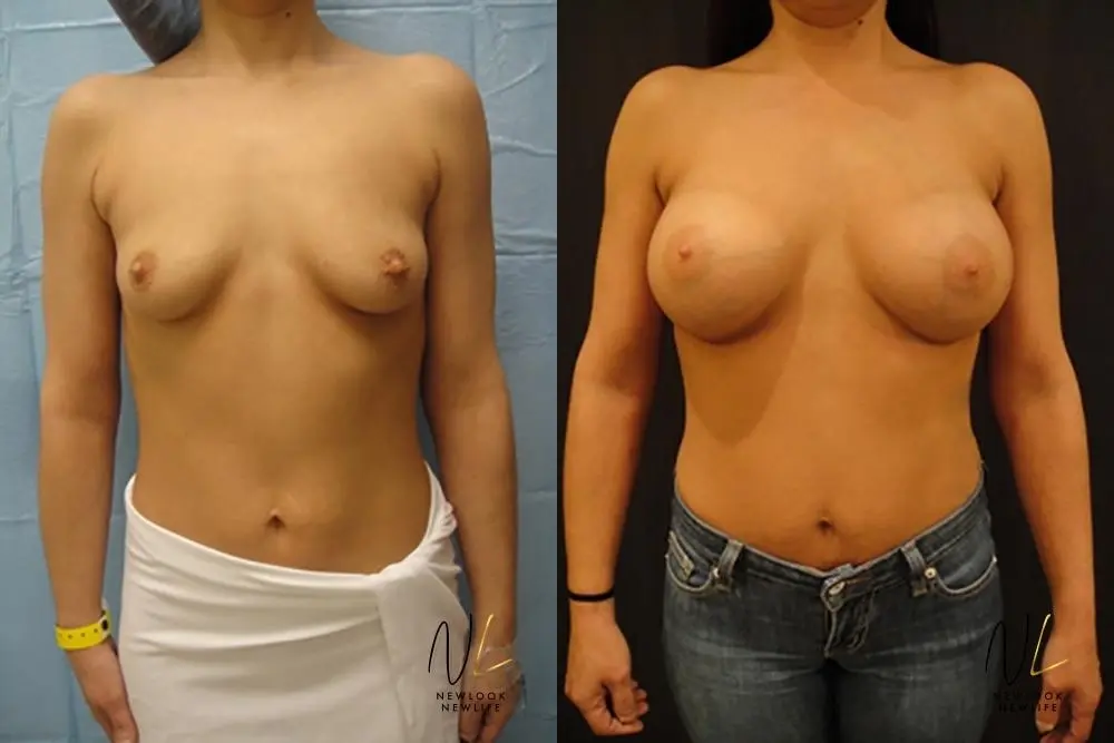 Breast Augmentation: Patient 10 - Before and After  