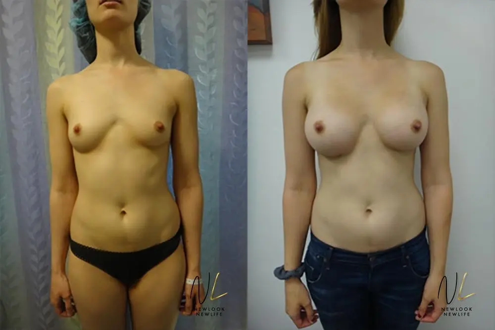 Breast Augmentation: Patient 7 - Before and After  