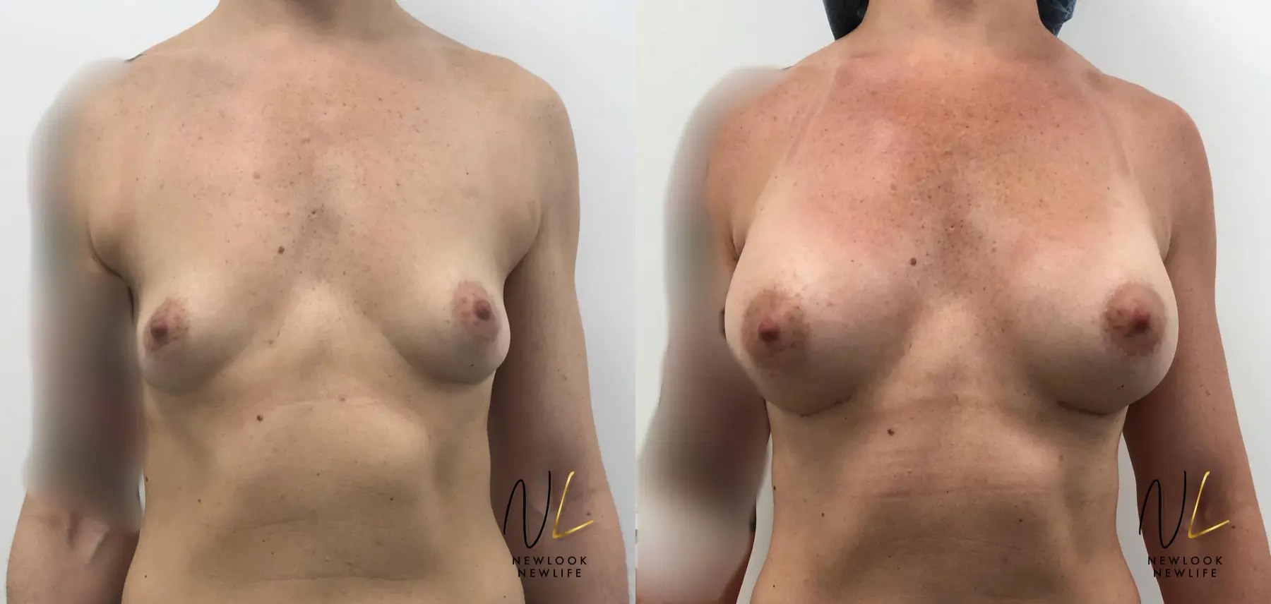 Breast Augmentation: Patient 2 - Before and After  