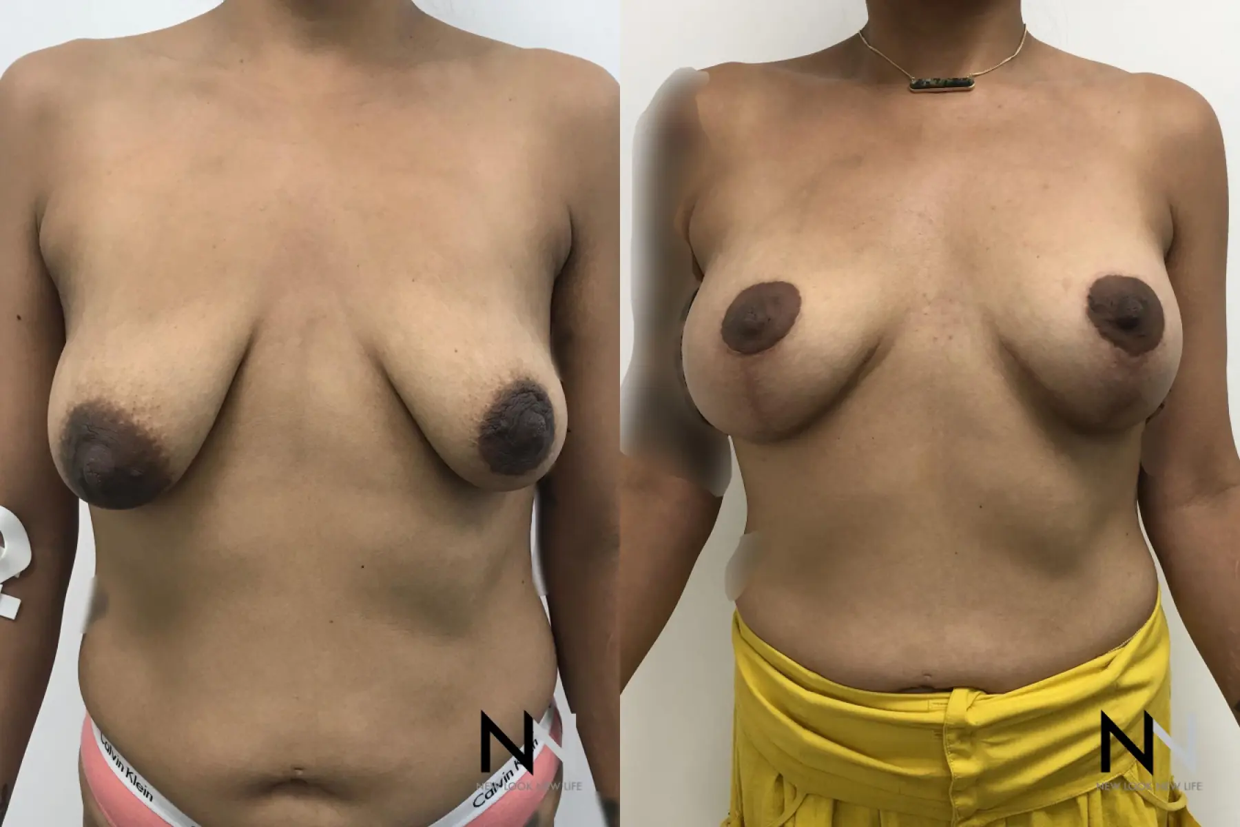 Breast Lift: Patient 2 - Before and After  