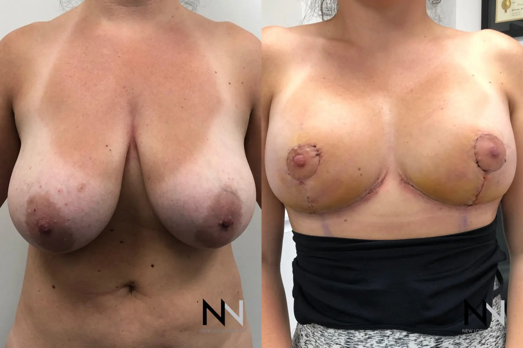 Breast Lift: Patient 9 - Before and After  