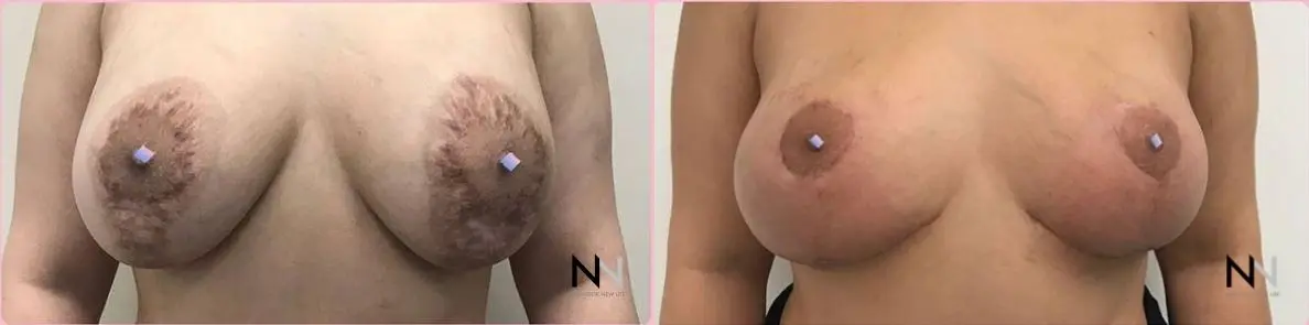 Breast Lift: Patient 10 - Before and After  