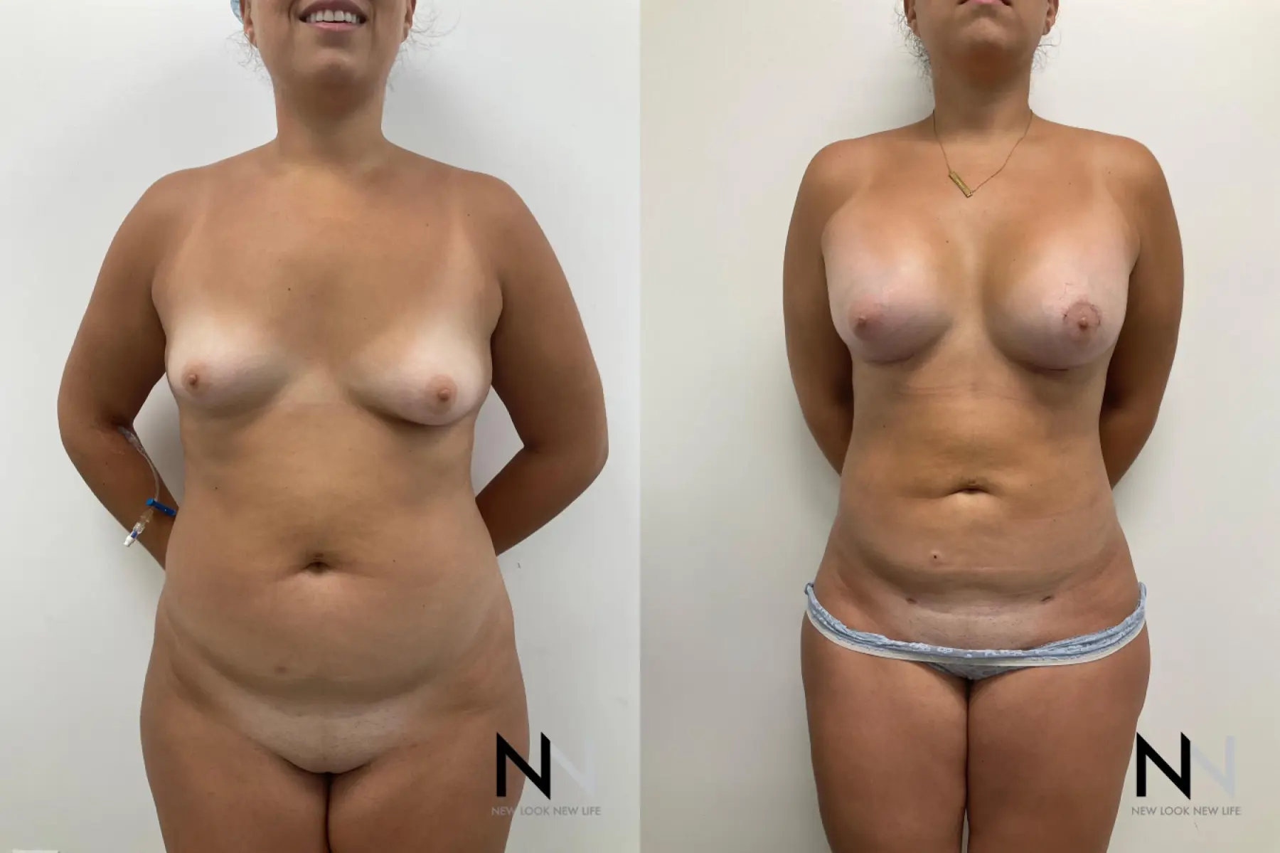 Breast Lift: Patient 3 - Before and After  