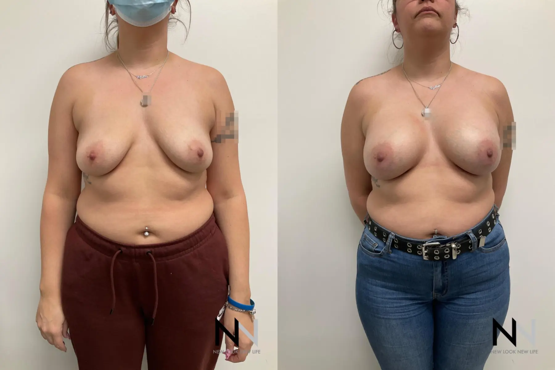 Breast Lift: Patient 1 - Before and After  