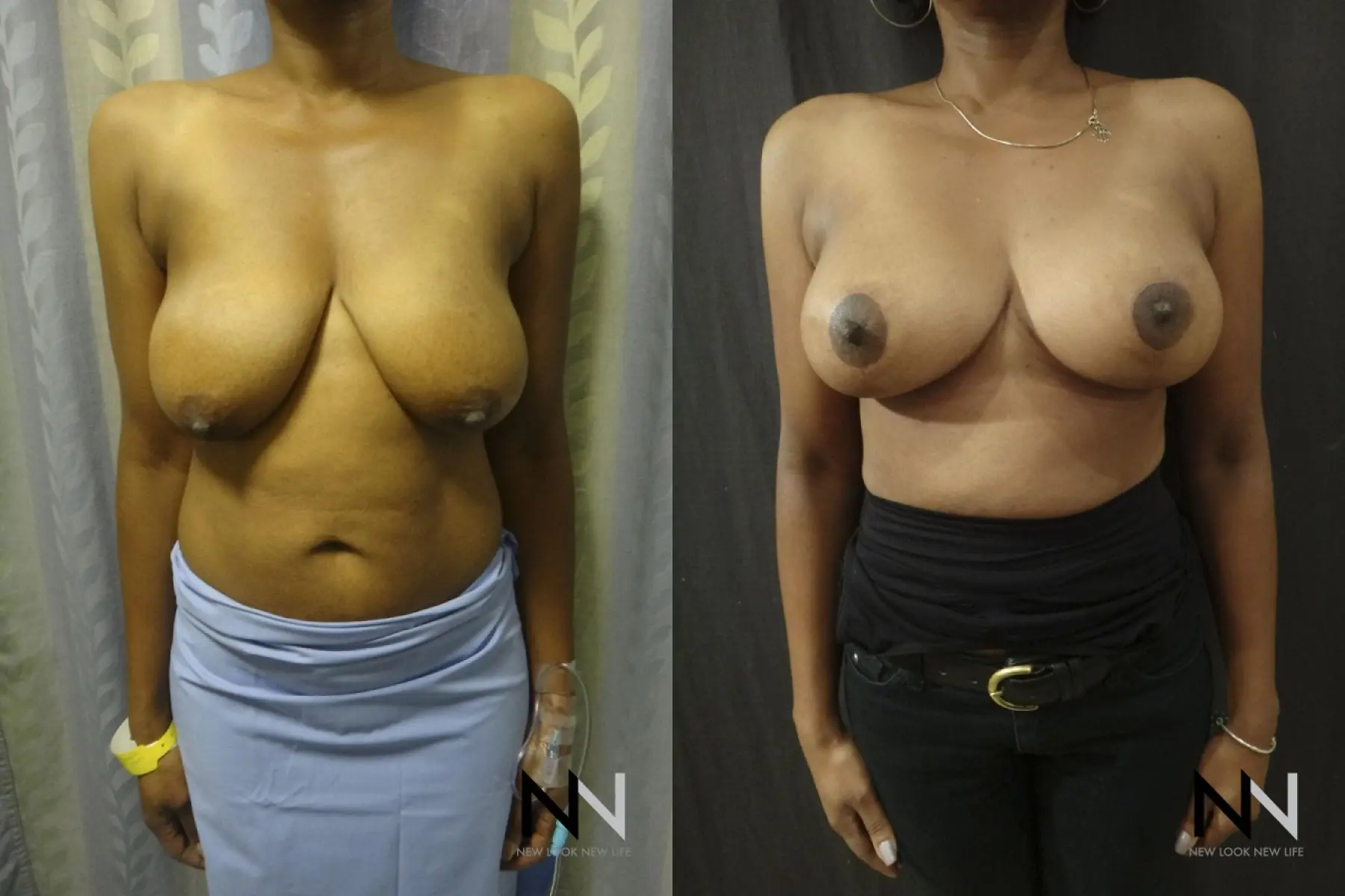 Breast Lift: Patient 4 - Before and After  