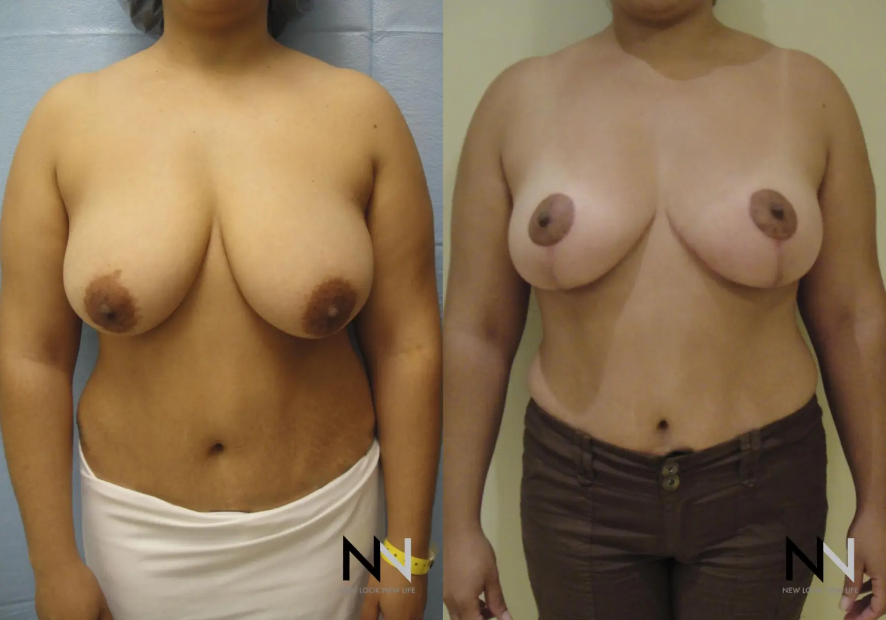 Breast Lift: Patient 7 - Before and After  