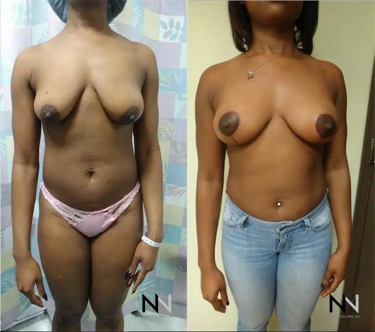 Breast Lift: Patient 6 - Before and After  