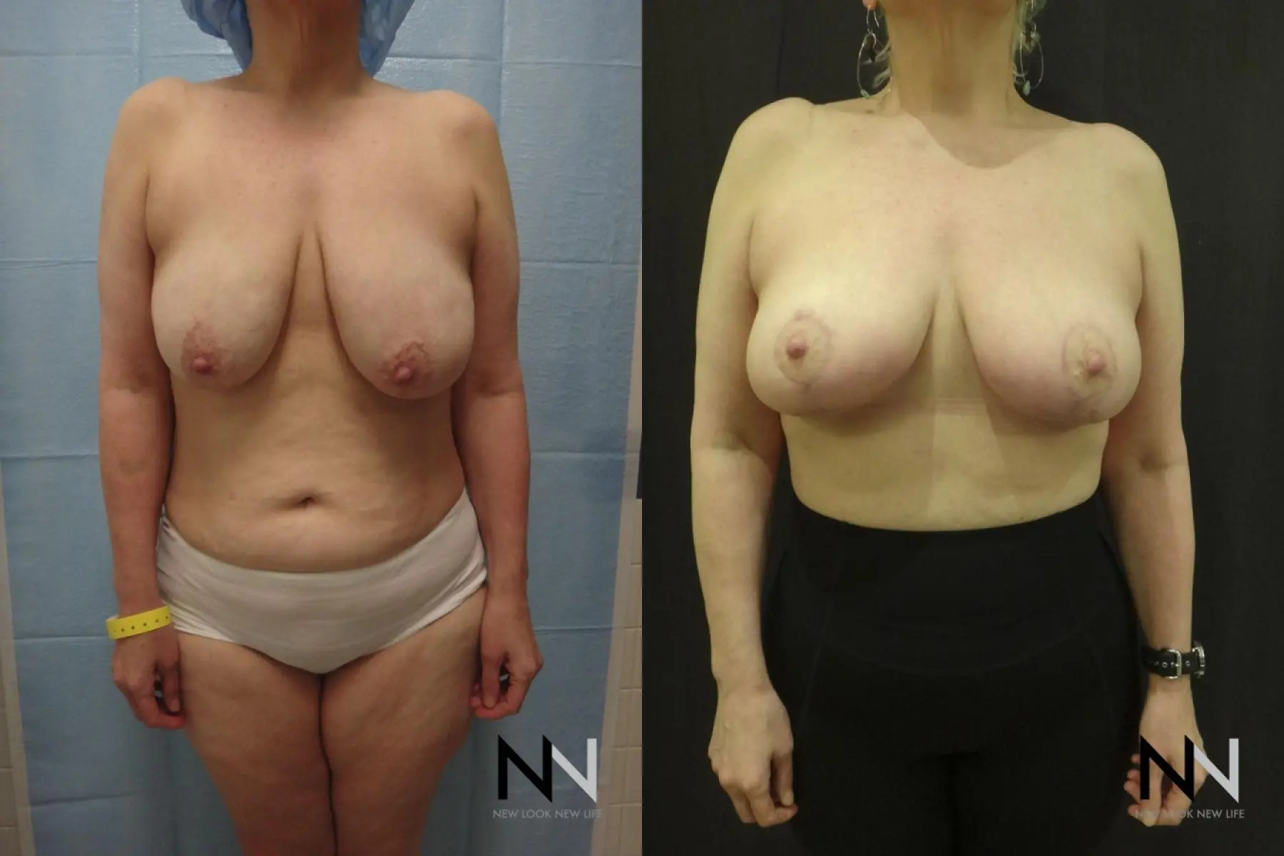 Breast Lift: Patient 5 - Before and After  