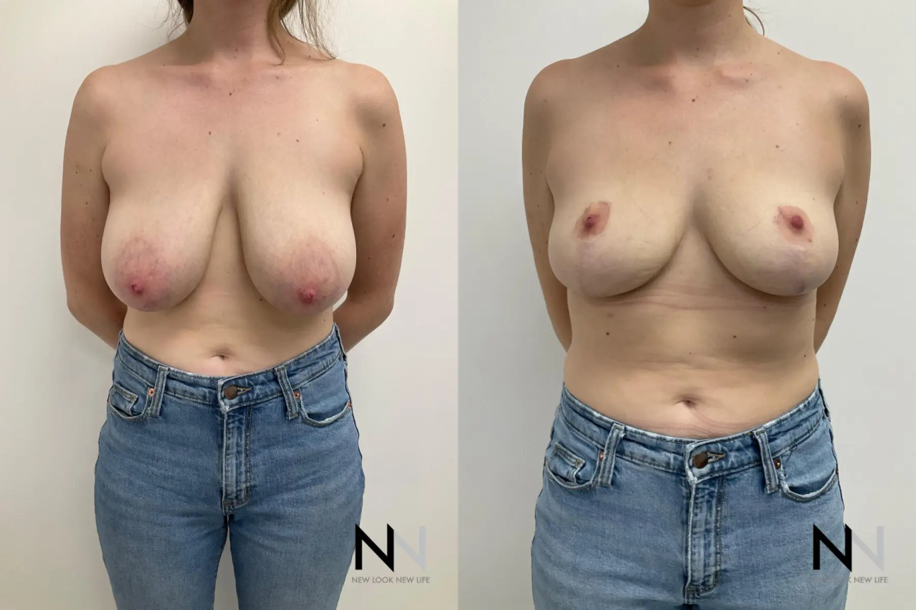 Breast Reduction: Patient 1 - Before and After  