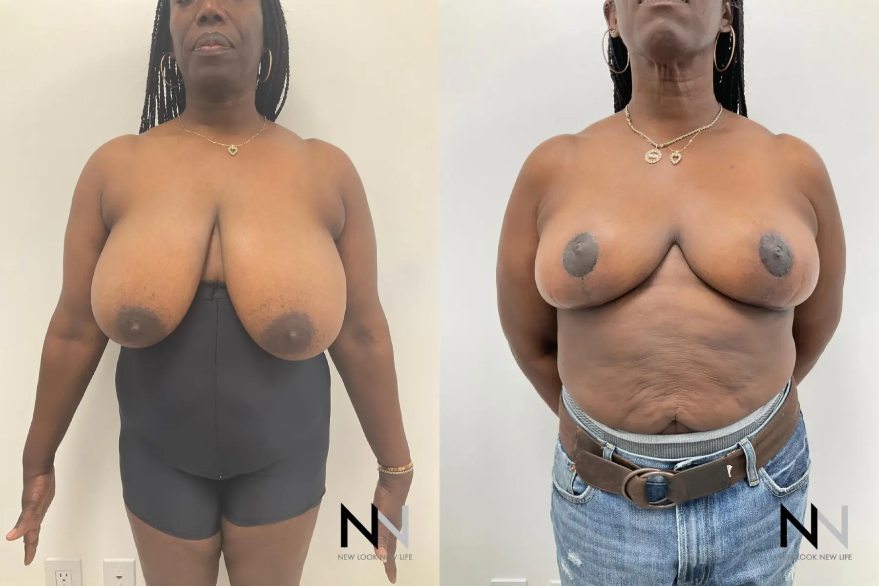 Breast Reduction: Patient 2 - Before and After  