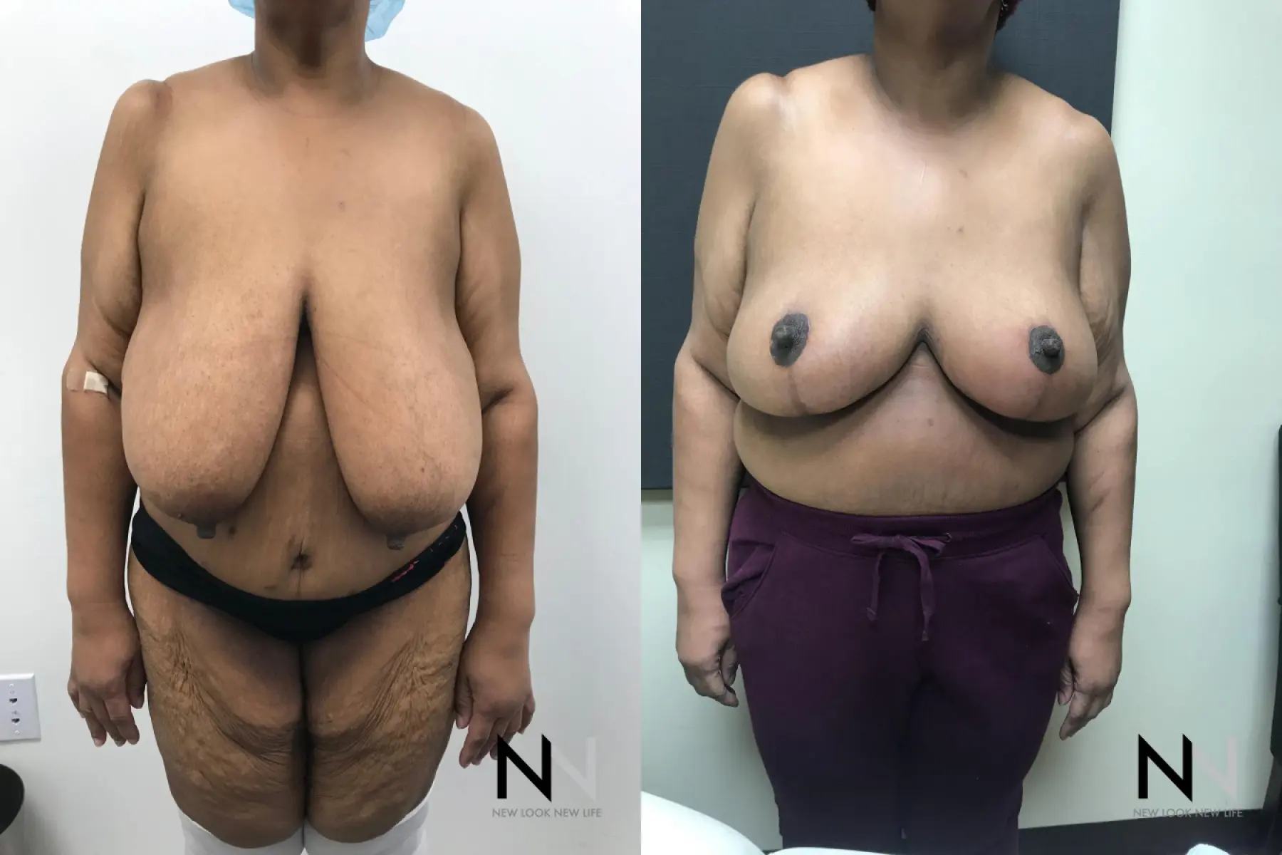 Breast Reduction: Patient 4 - Before and After  