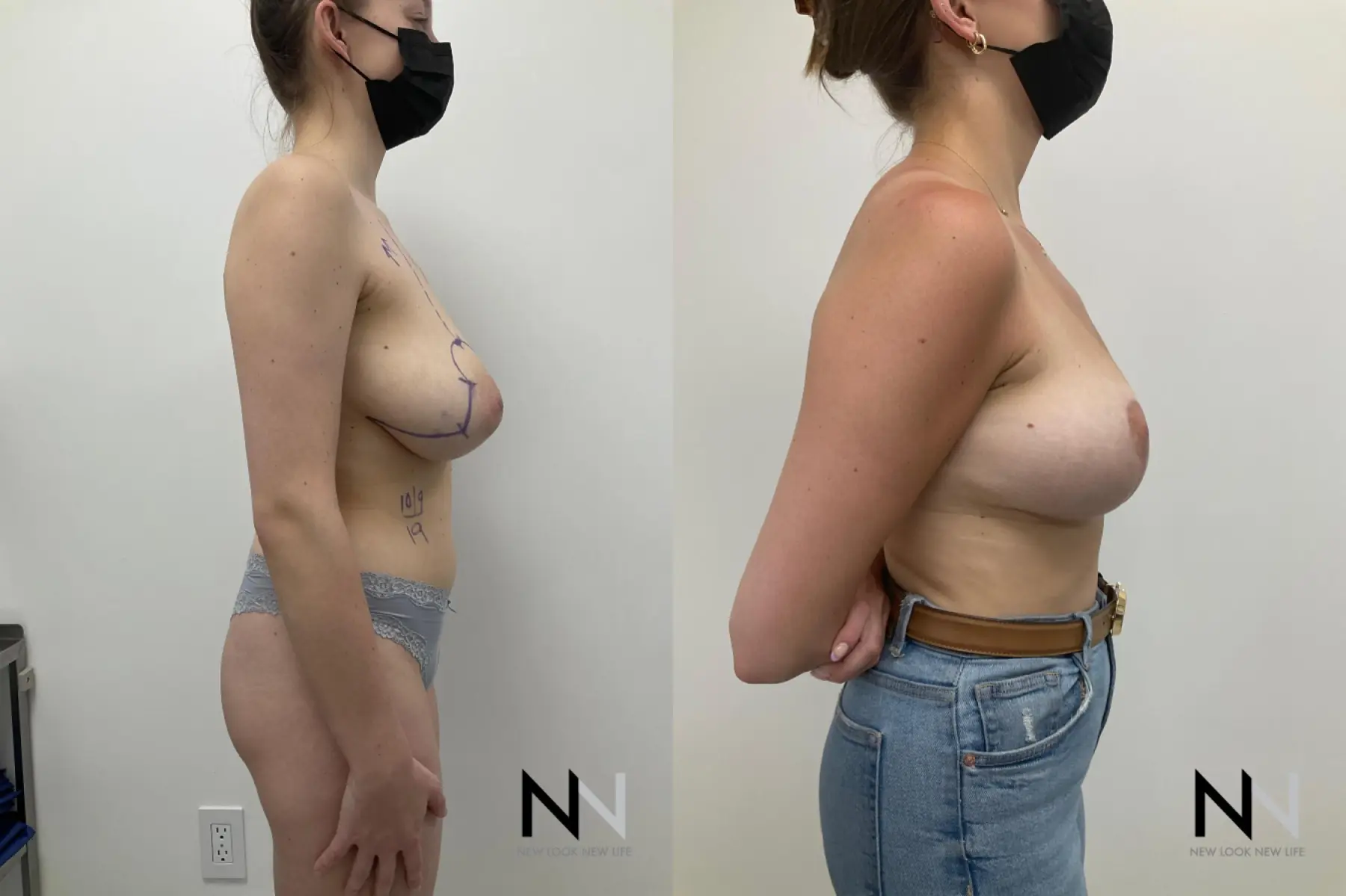 Breast Reduction: Patient 5 - Before and After  