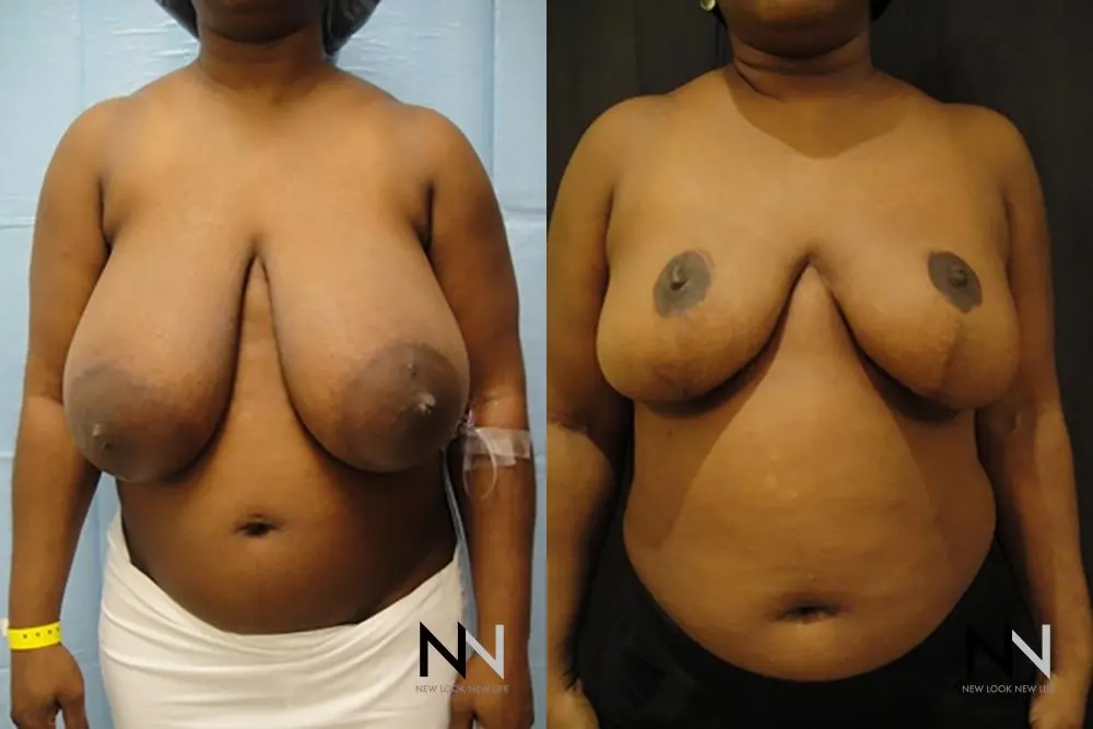 Breast Reduction: Patient 6 - Before and After  