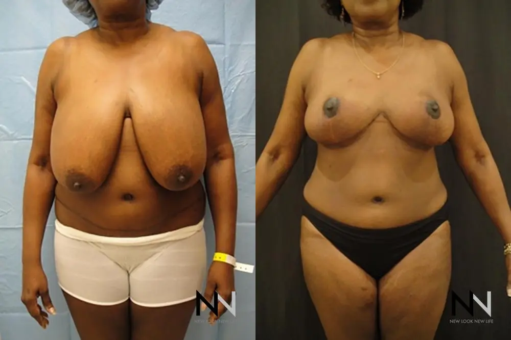 Breast Reduction: Patient 8 - Before and After  