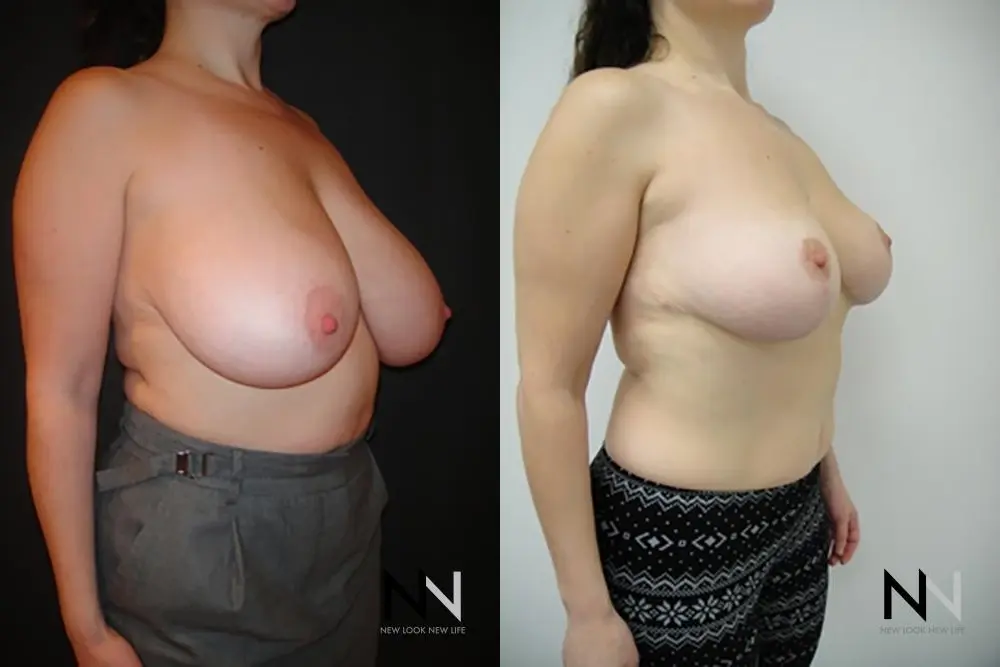 Breast Reduction: Patient 13 - Before and After 3