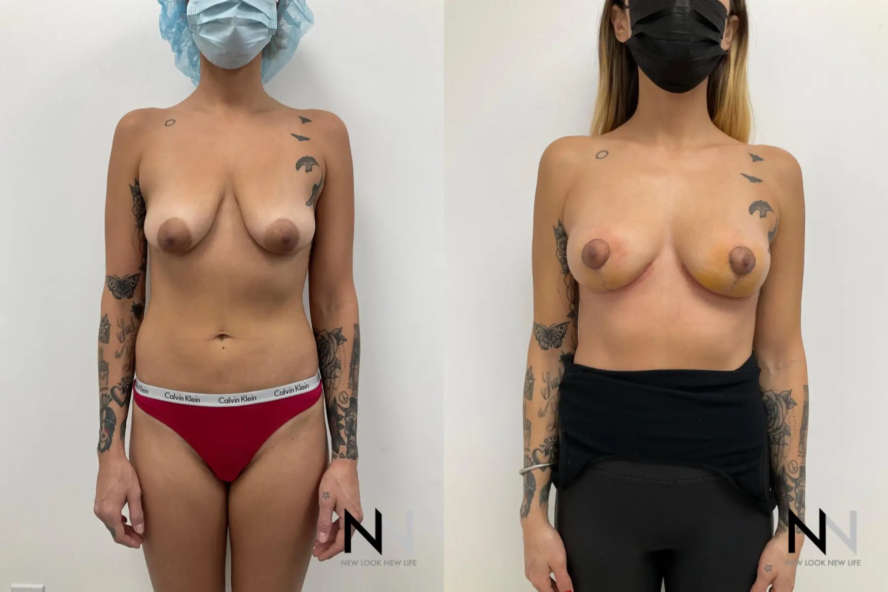 Breast Reduction: Patient 3 - Before and After  