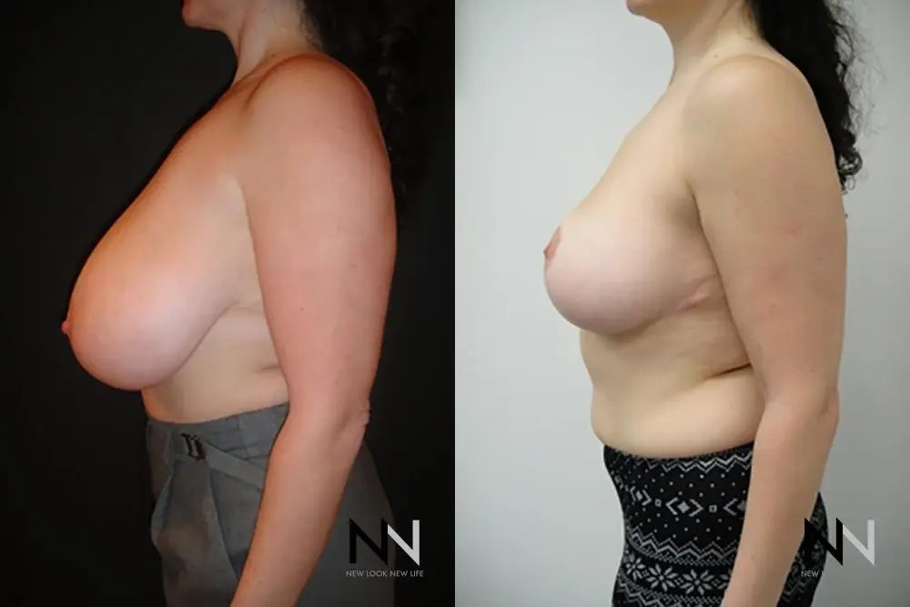 Breast Reduction: Patient 13 - Before and After 4