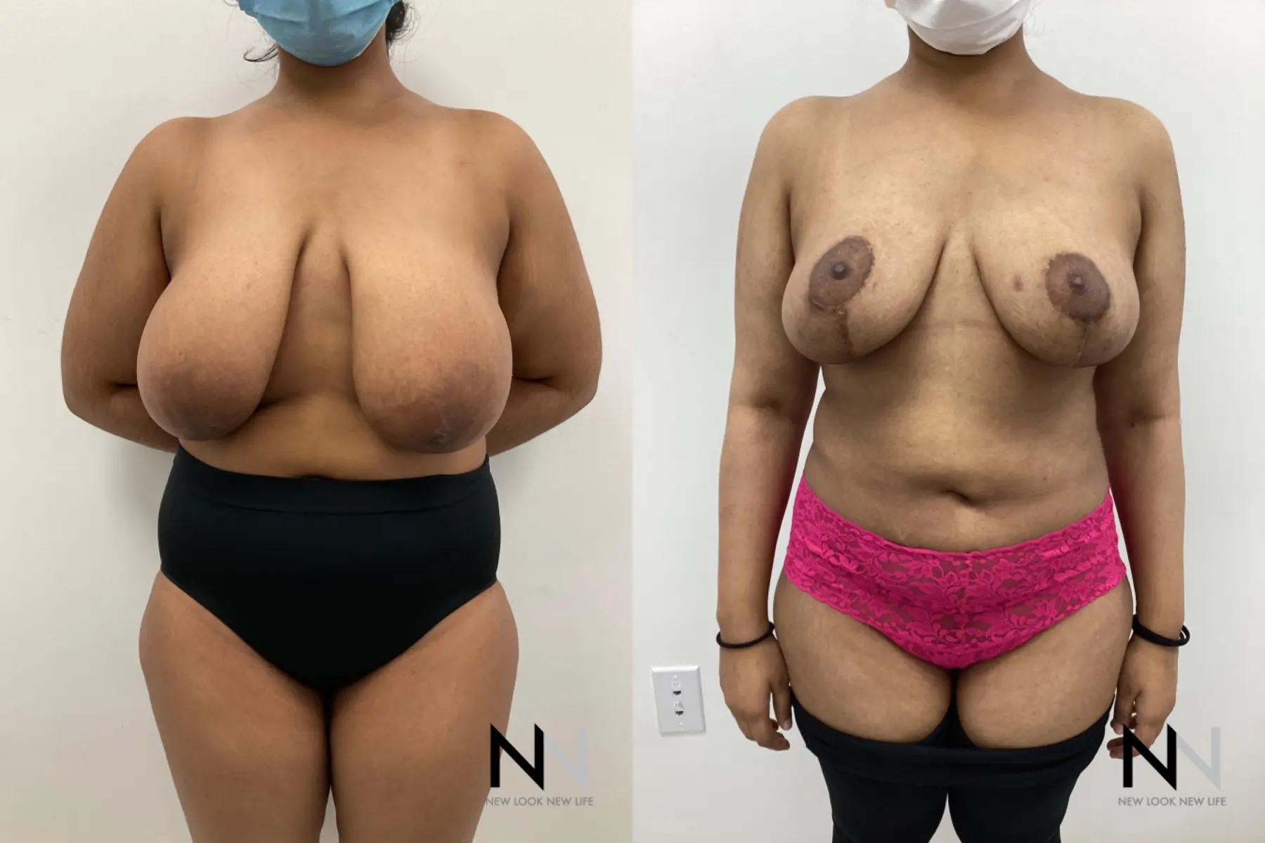 Breast Reduction: Patient 7 - Before and After  