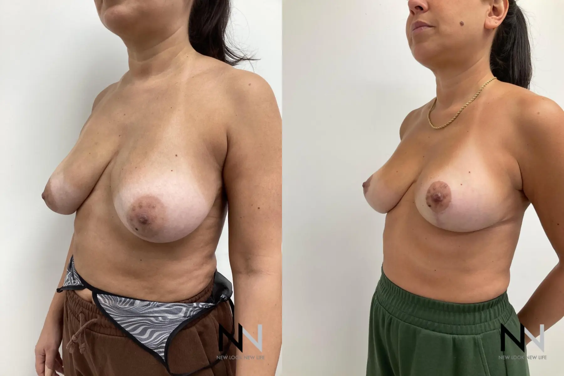 Breast Reduction: Patient 9 - Before and After  