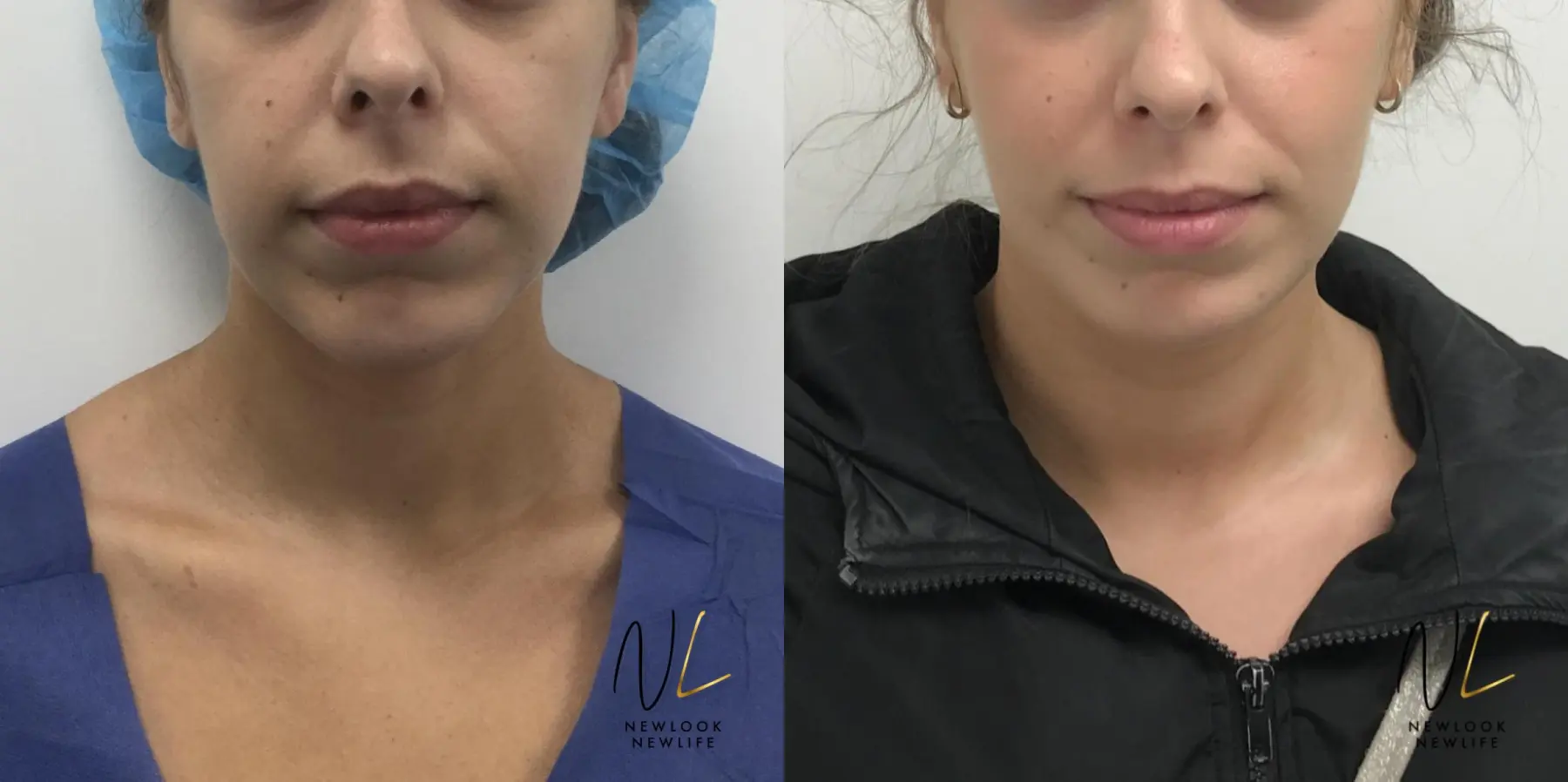 Chin Augmentation: Patient 6 - Before and After  