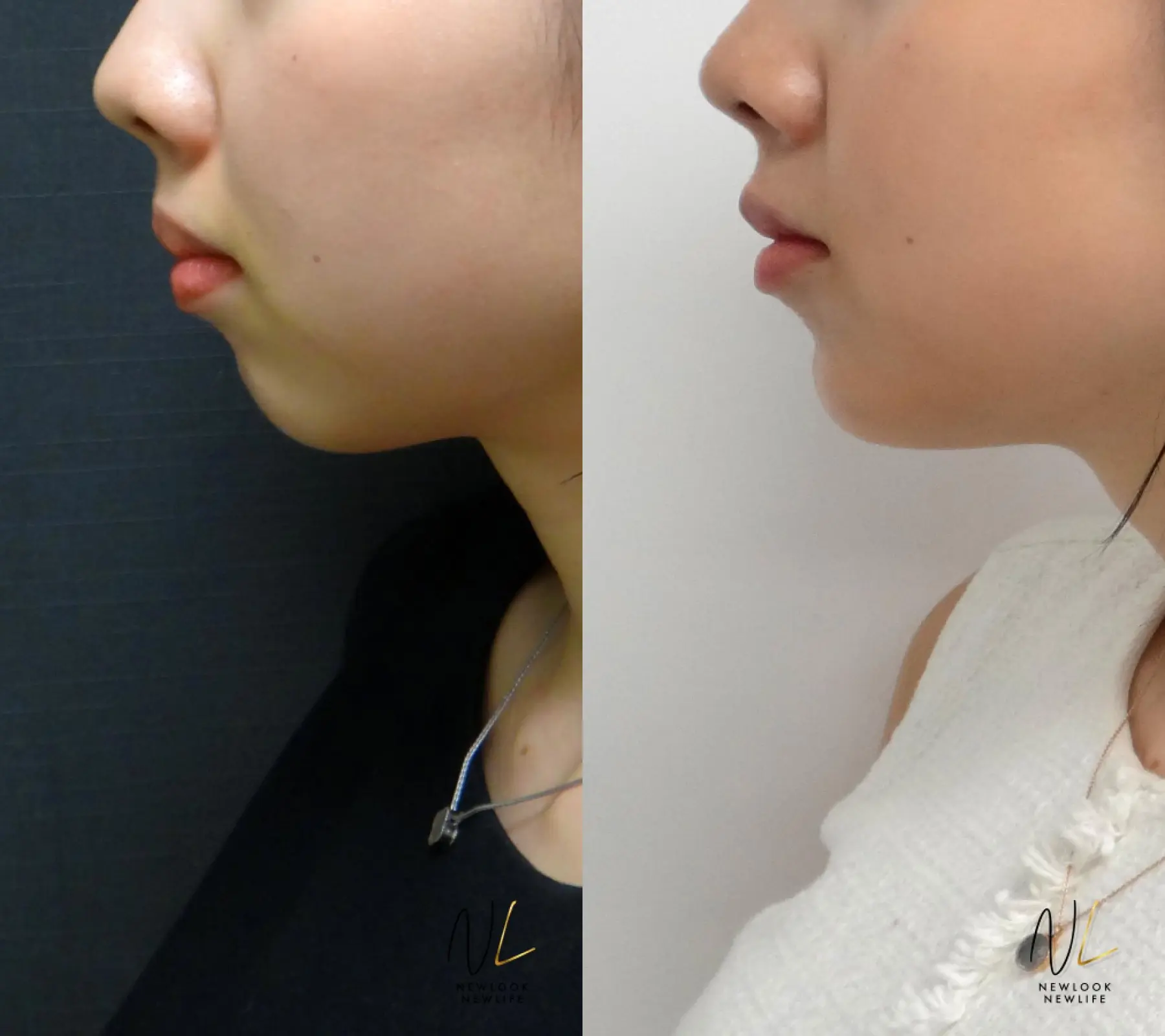 Chin Augmentation: Patient 2 - Before and After  