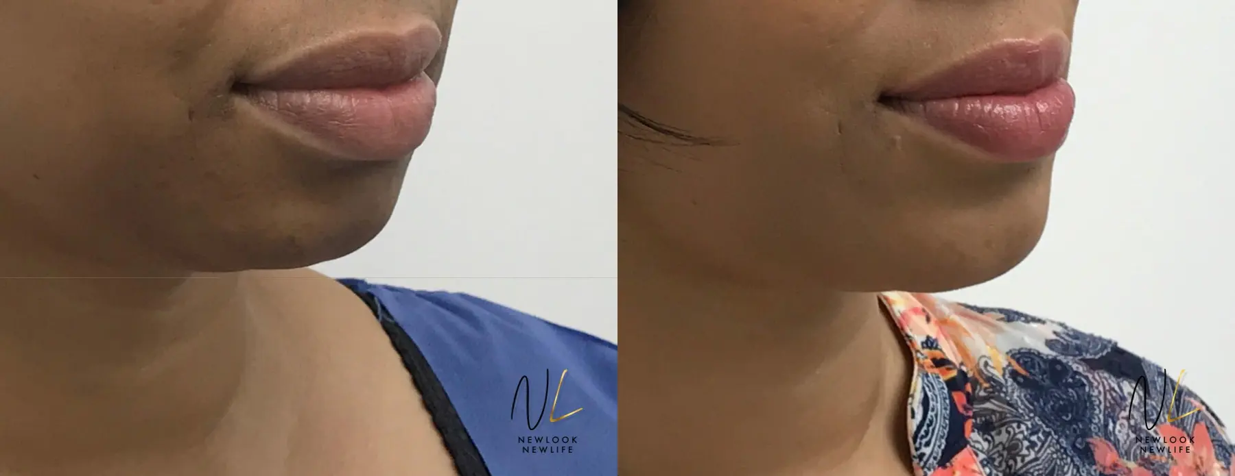 Chin Augmentation: Patient 3 - Before and After 1