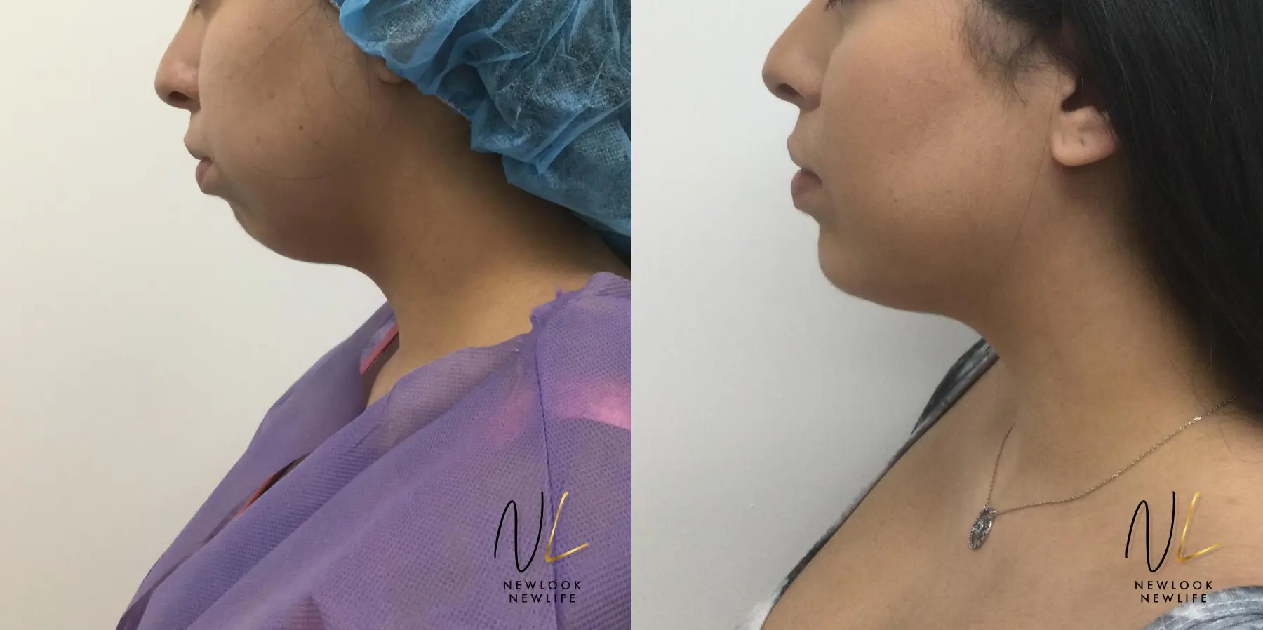 Chin Augmentation: Patient 7 - Before and After  