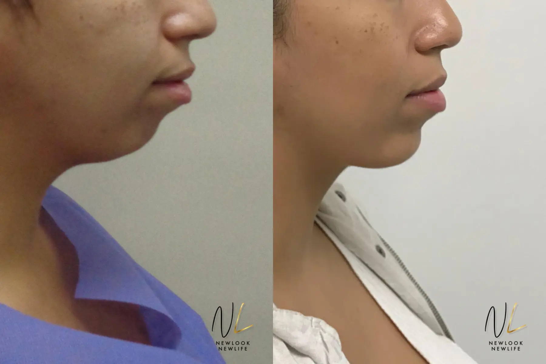 Chin Augmentation: Patient 1 - Before and After  