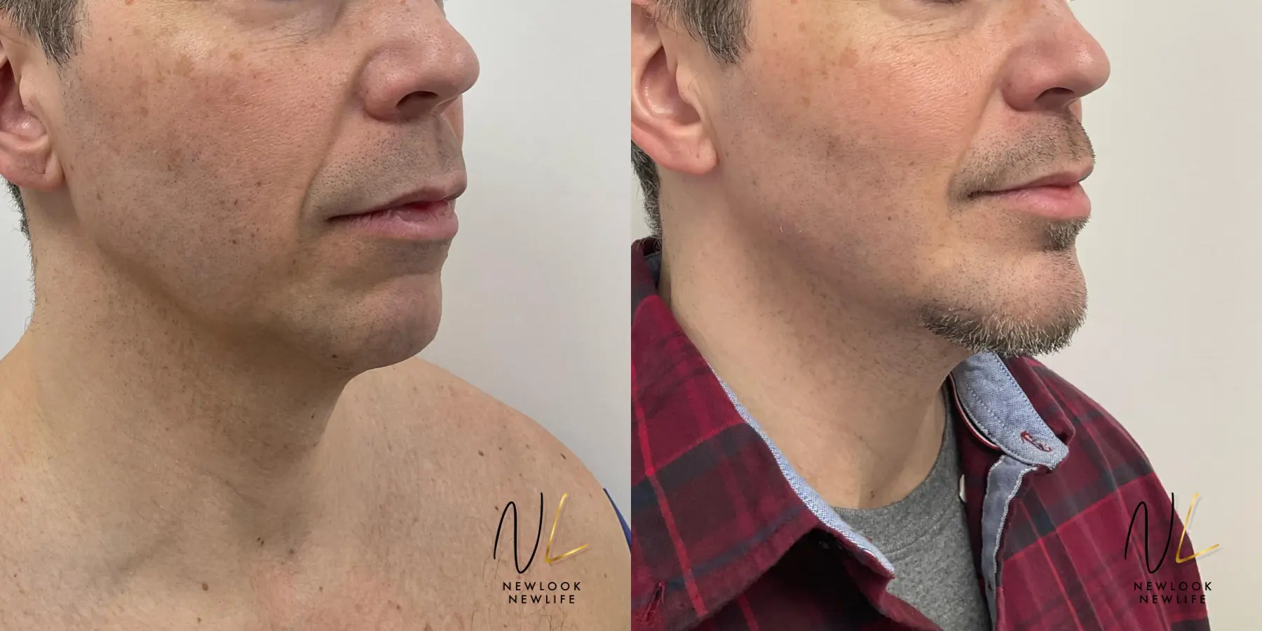 Chin Augmentation: Patient 5 - Before and After  