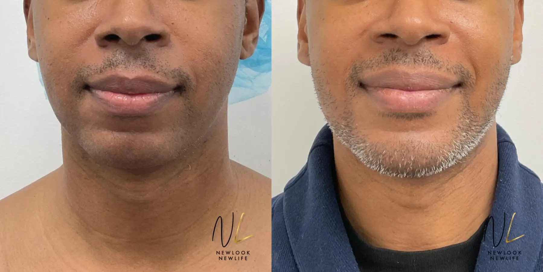 Chin Augmentation: Patient 4 - Before and After  