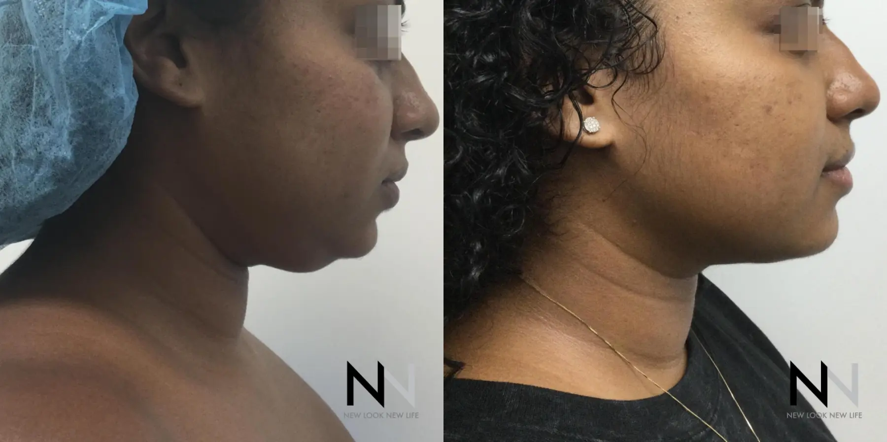 Chin Liposuction: Patient 9 - Before and After  