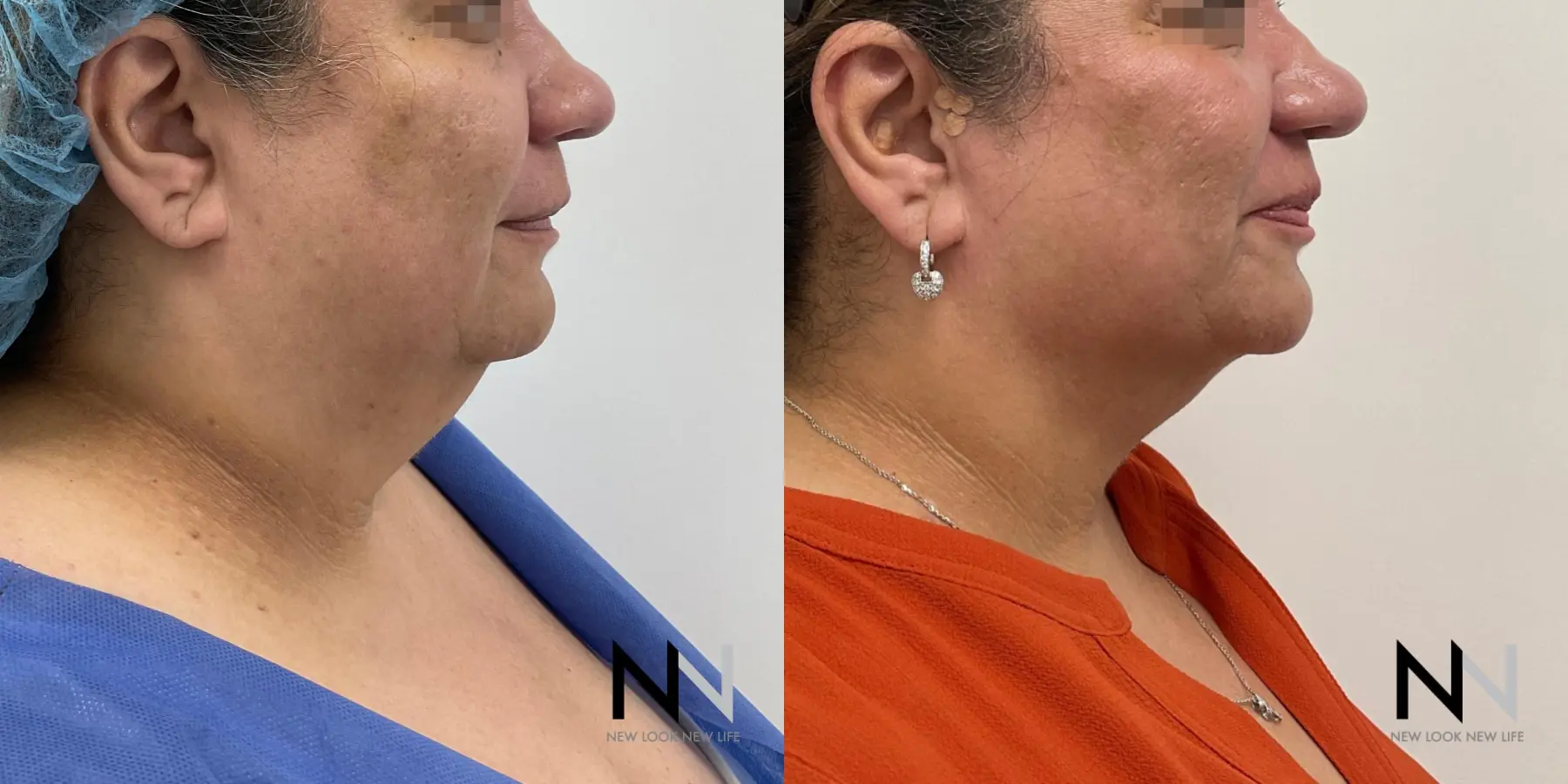 Chin Liposuction: Patient 10 - Before and After  