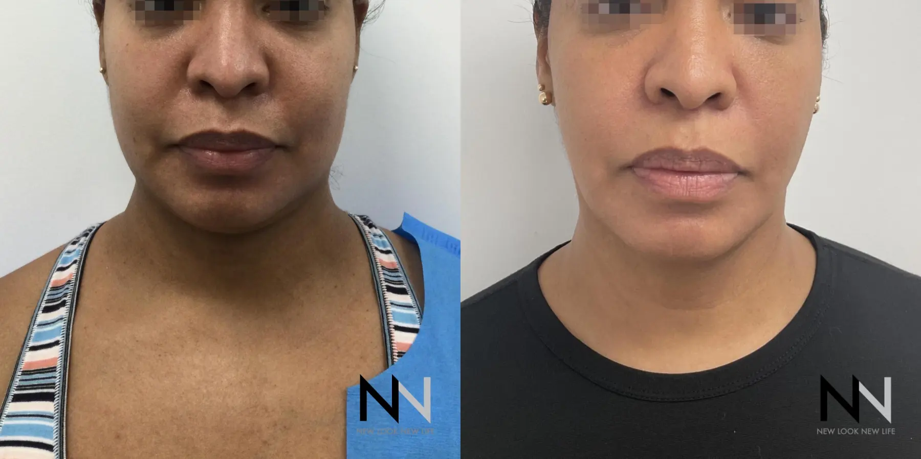 Chin Liposuction: Patient 7 - Before and After  