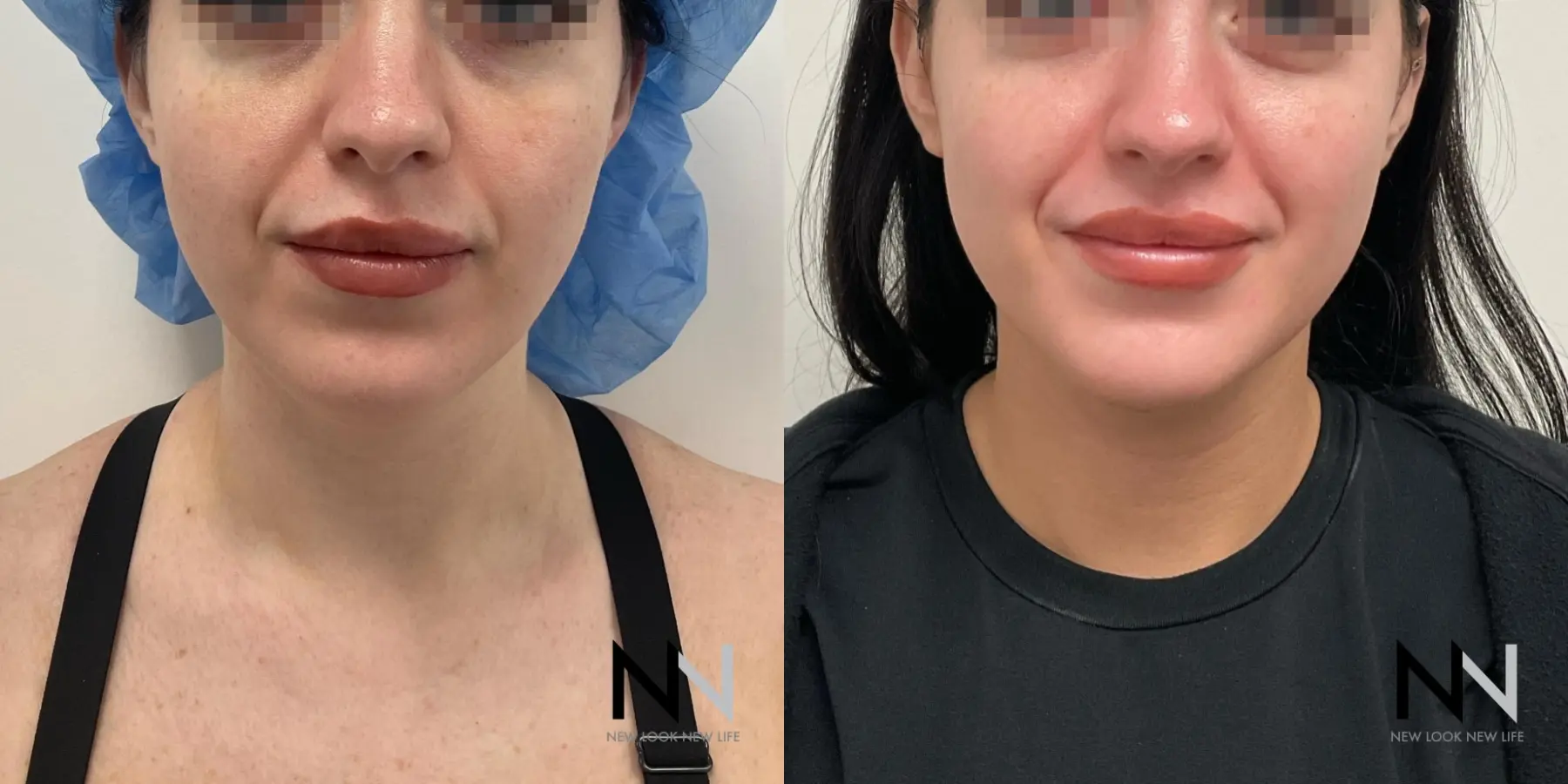 Chin Liposuction: Patient 3 - Before and After  