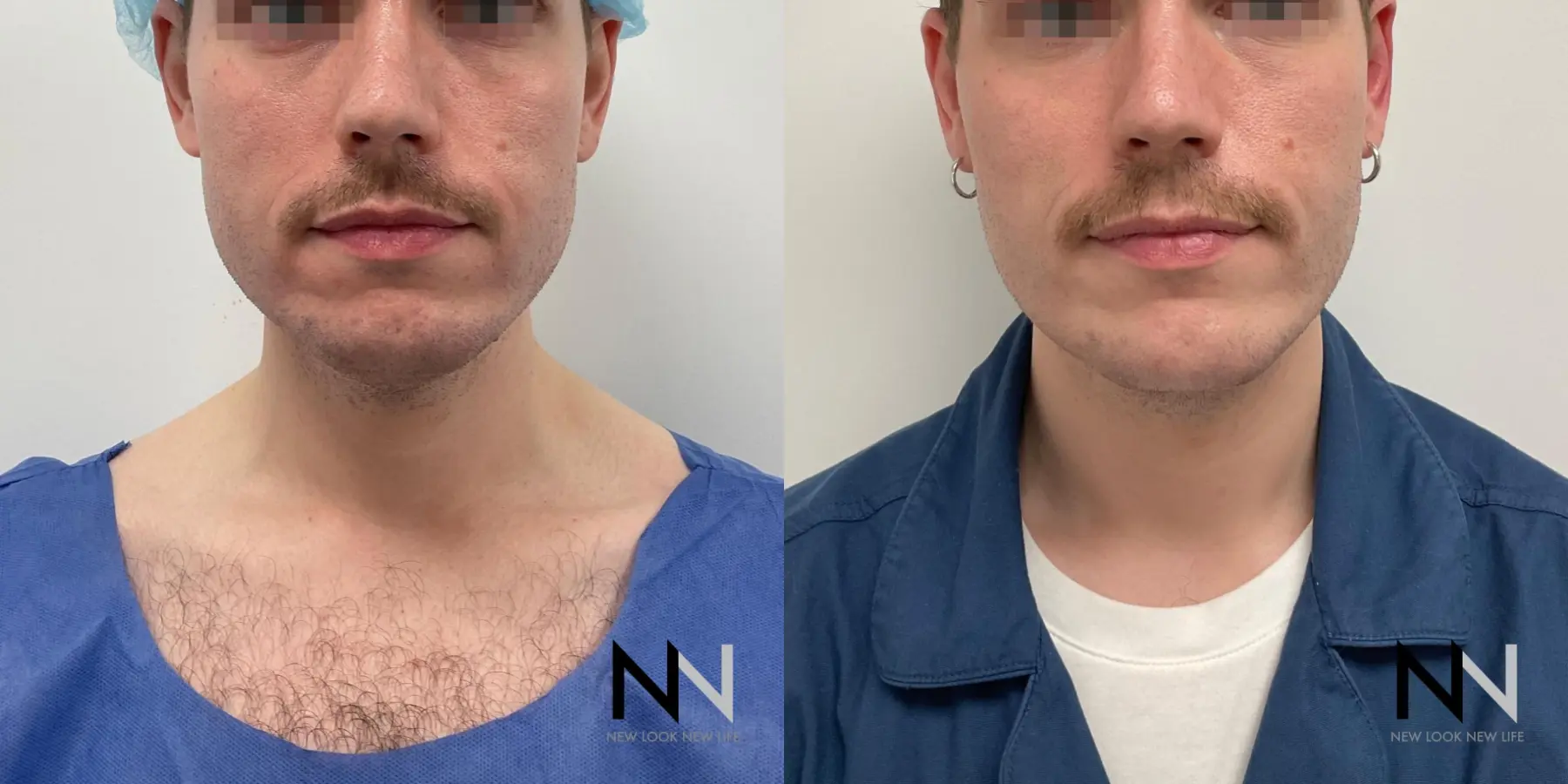 Chin Liposuction: Patient 1 - Before and After  