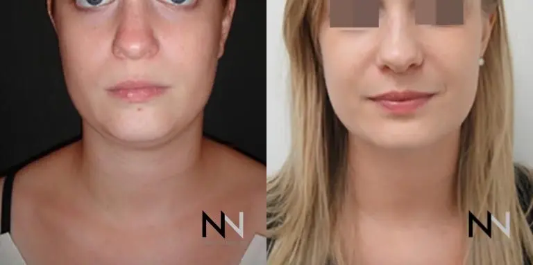 Chin Liposuction: Patient 2 - Before and After  