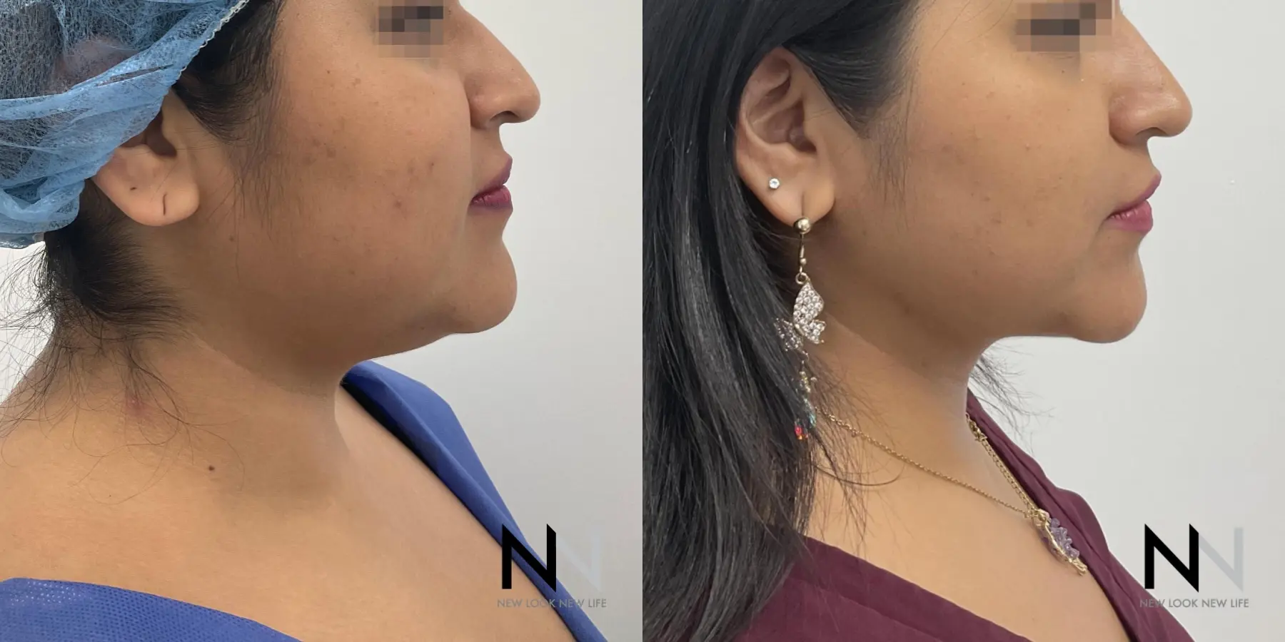 Chin Liposuction: Patient 4 - Before and After  