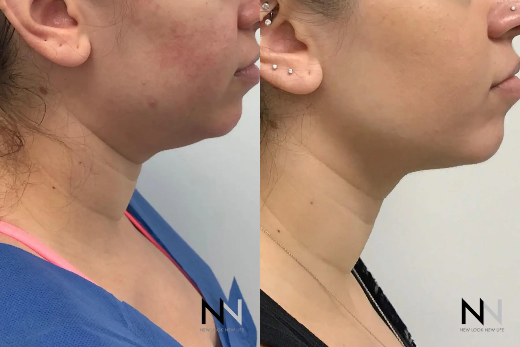 Chin Liposuction: Patient 6 - Before and After  