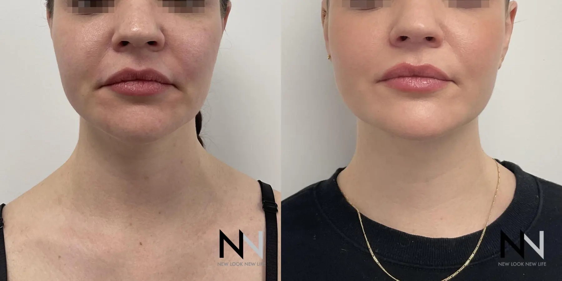 Chin Liposuction: Patient 8 - Before and After  