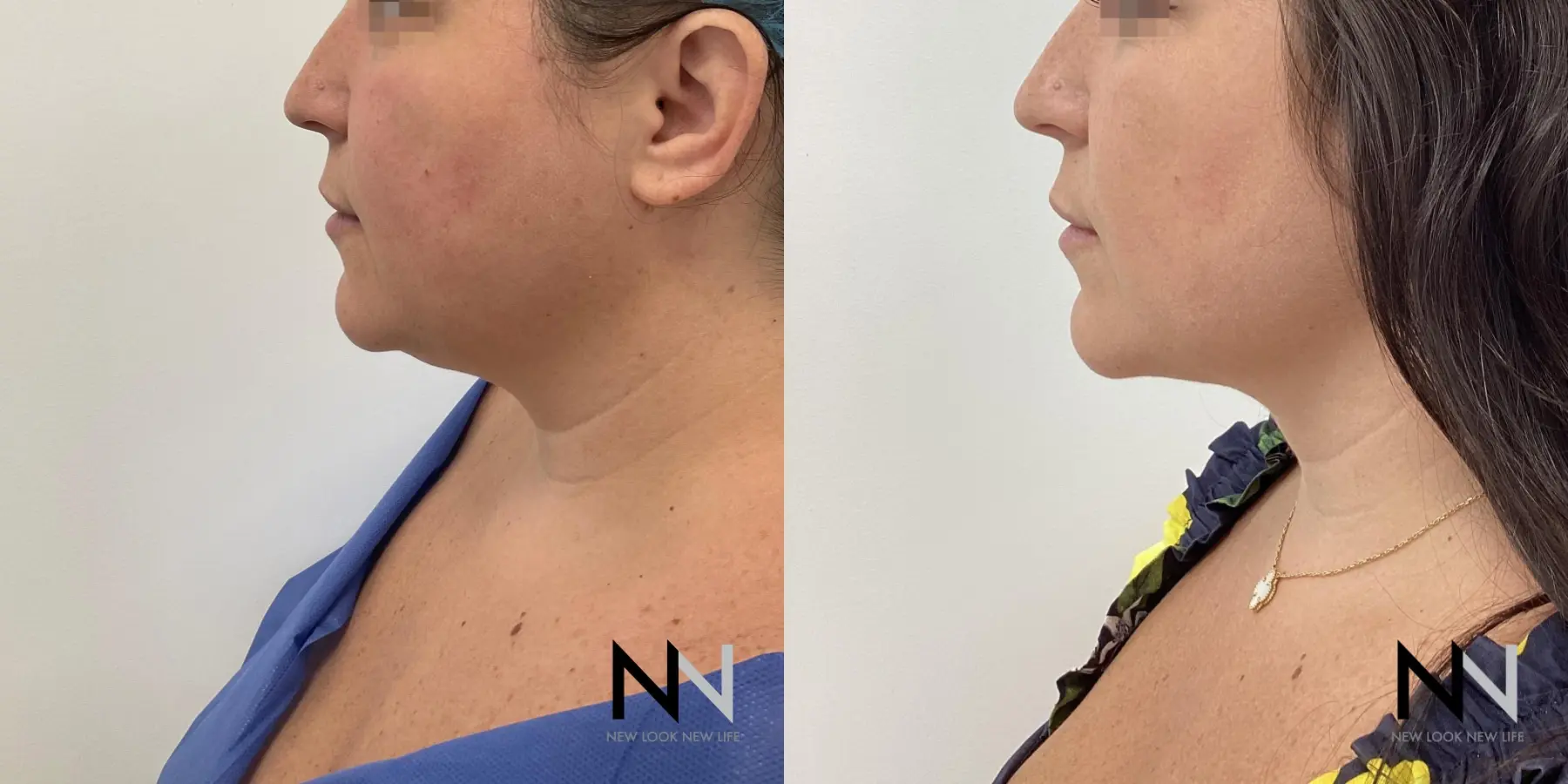 Chin Liposuction: Patient 5 - Before and After  