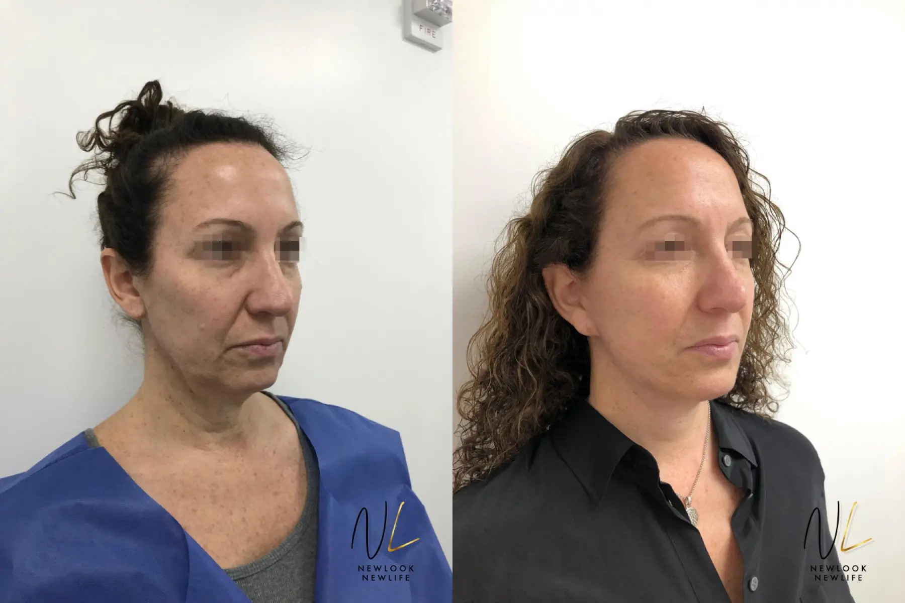 Facelift: Patient 5 - Before and After  